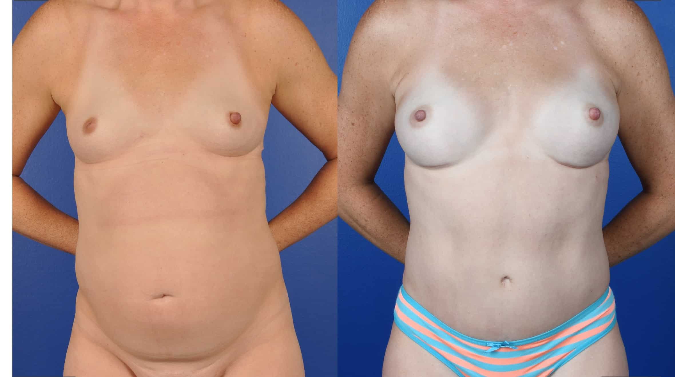 Before and After Image: Abdominoplasty, 360 Liposuction, Axillary Liposuction, Breast Augmentation – Silicone, Inverted Nipple Repair - front