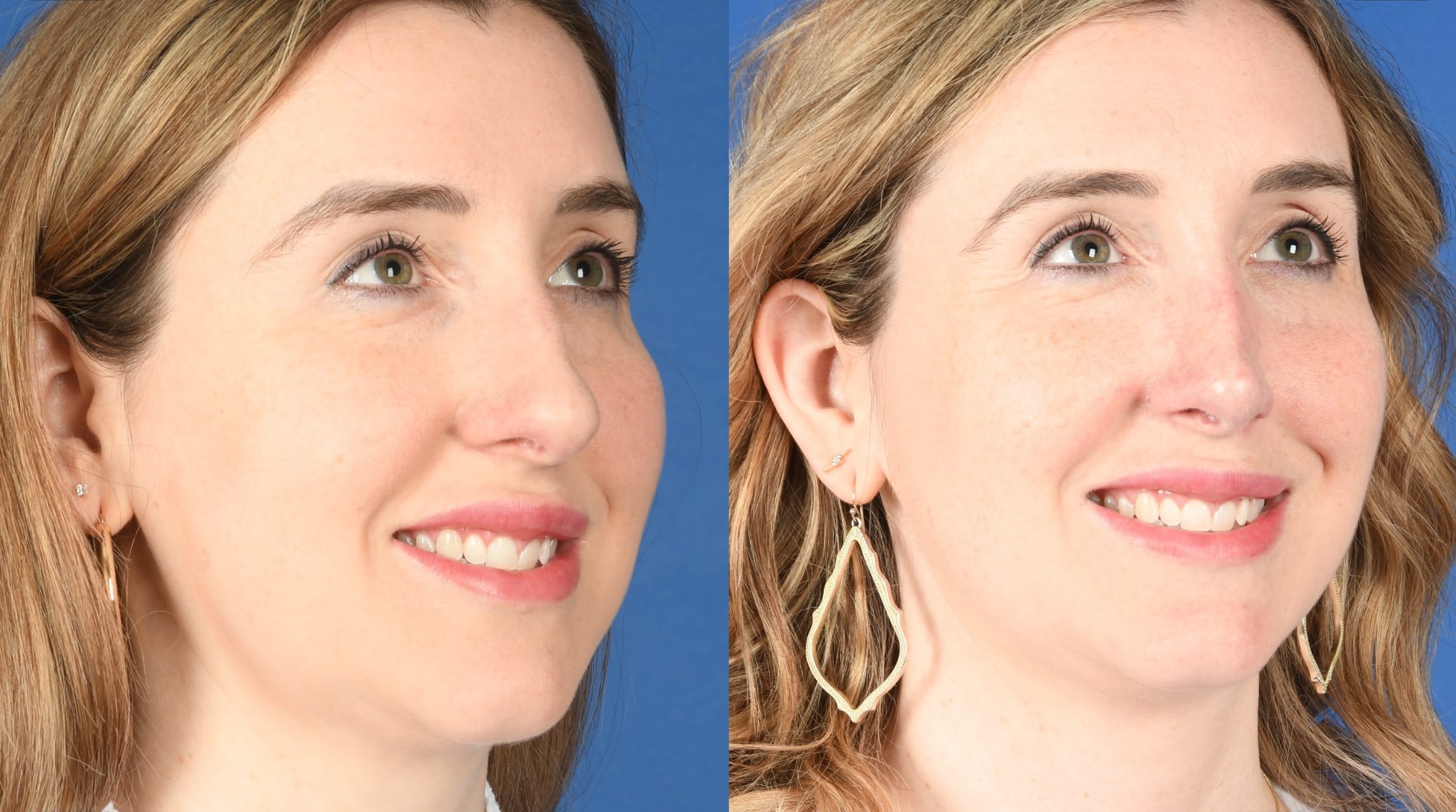Before and After Image: Primary Rhinoplasty - right-front-oblique