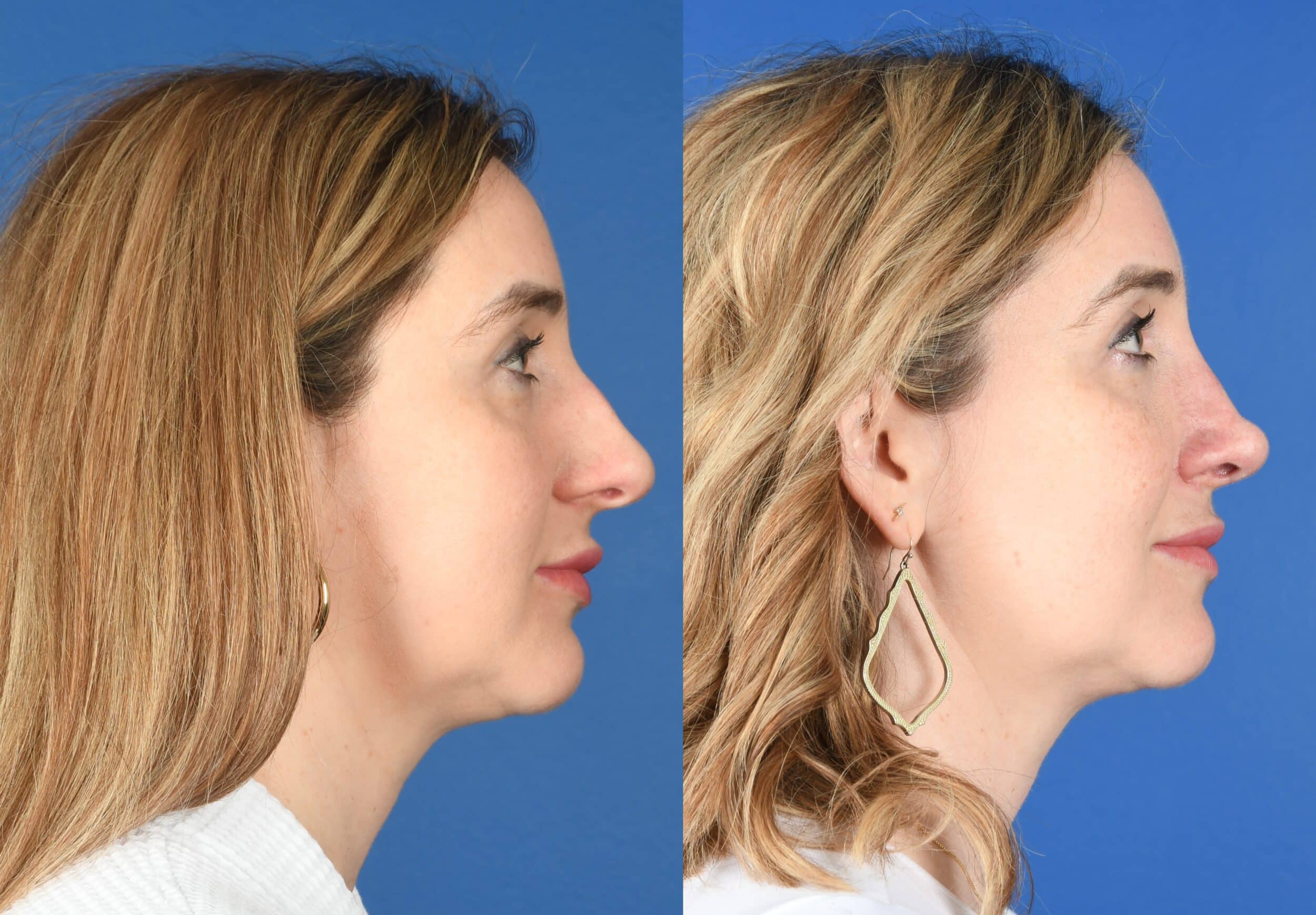 Before and After Image: Primary Rhinoplasty - right-side