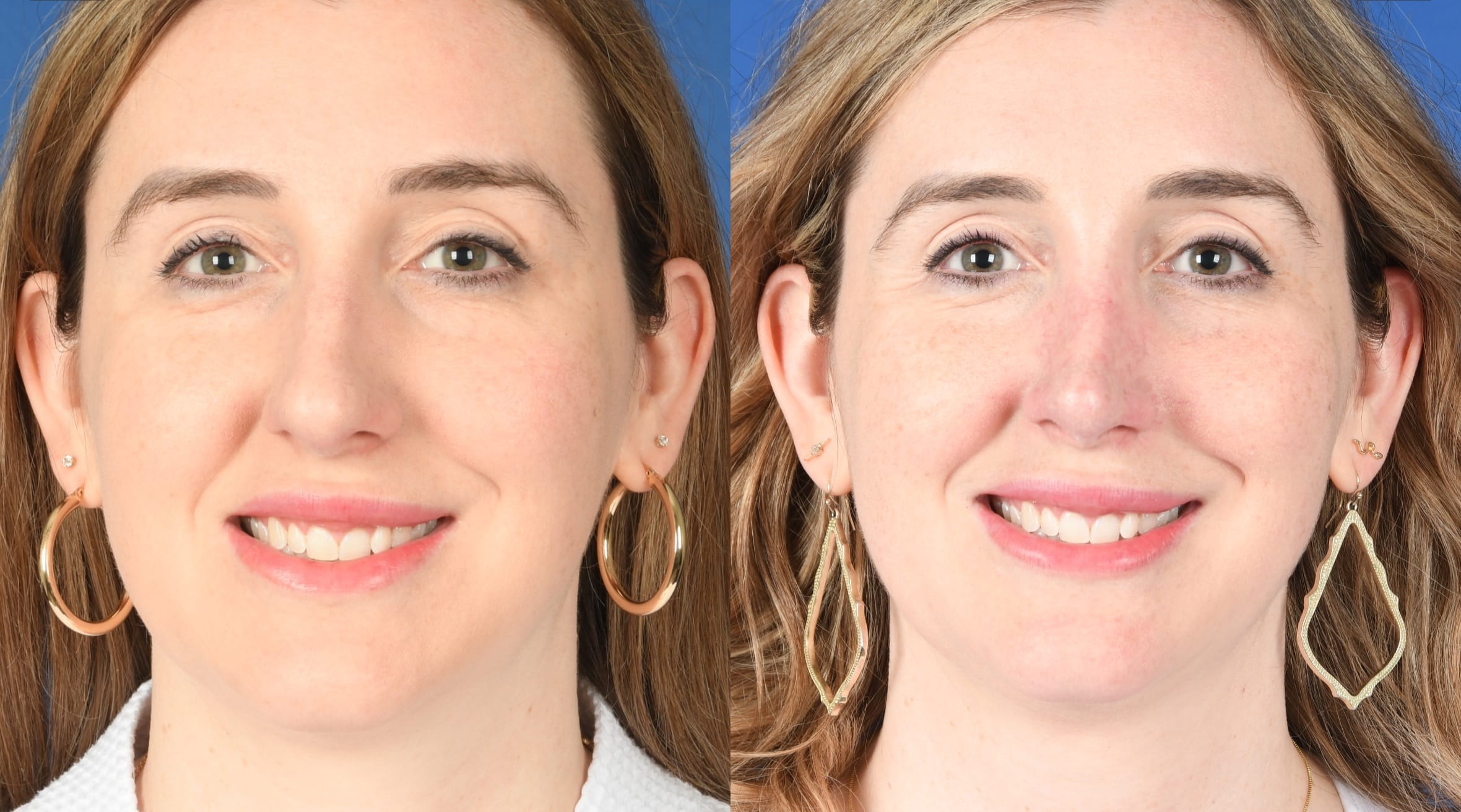 Before and After Image: Primary Rhinoplasty - front