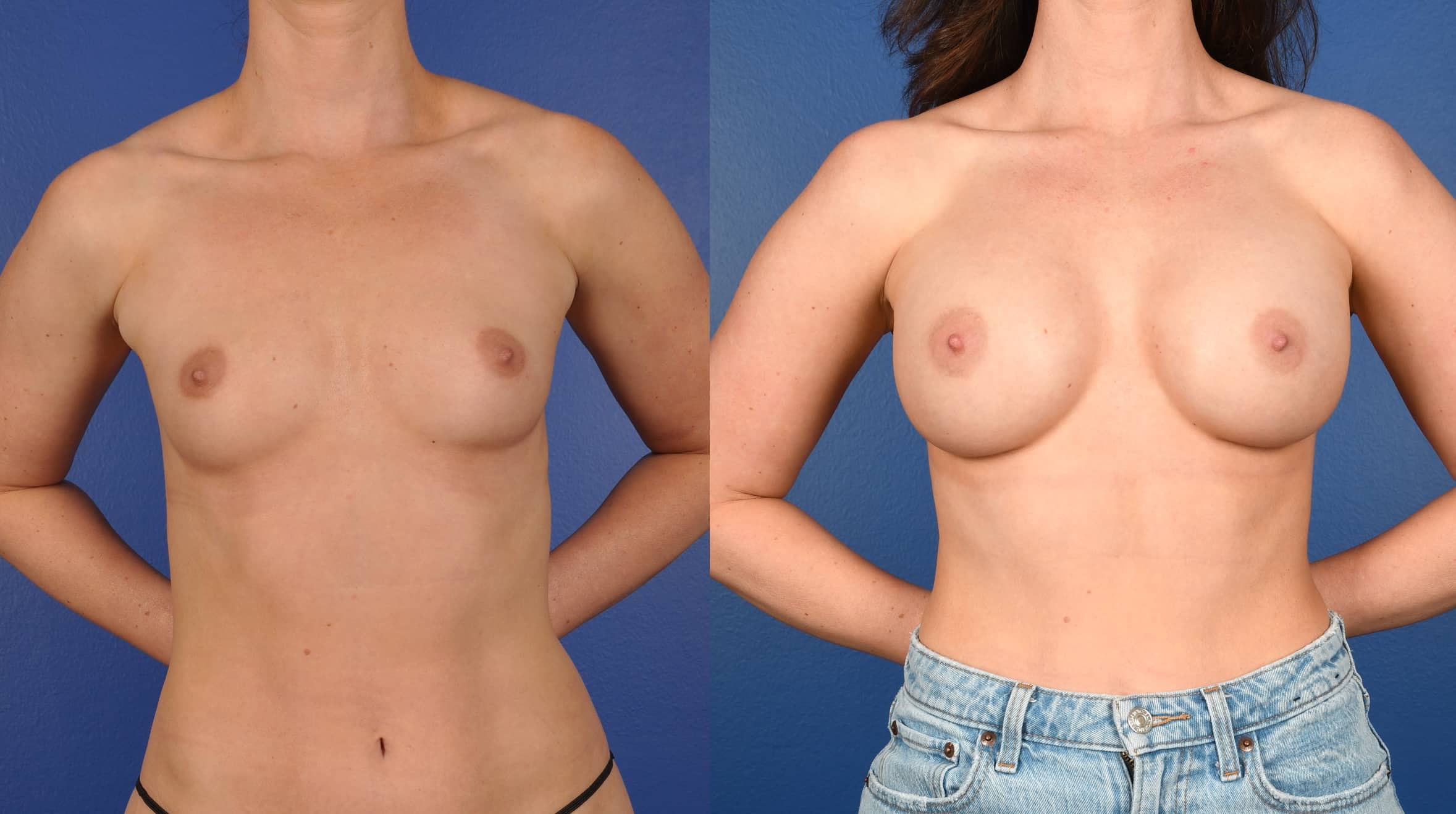 Before and After Image: Breast Augmentation – Silicone - front