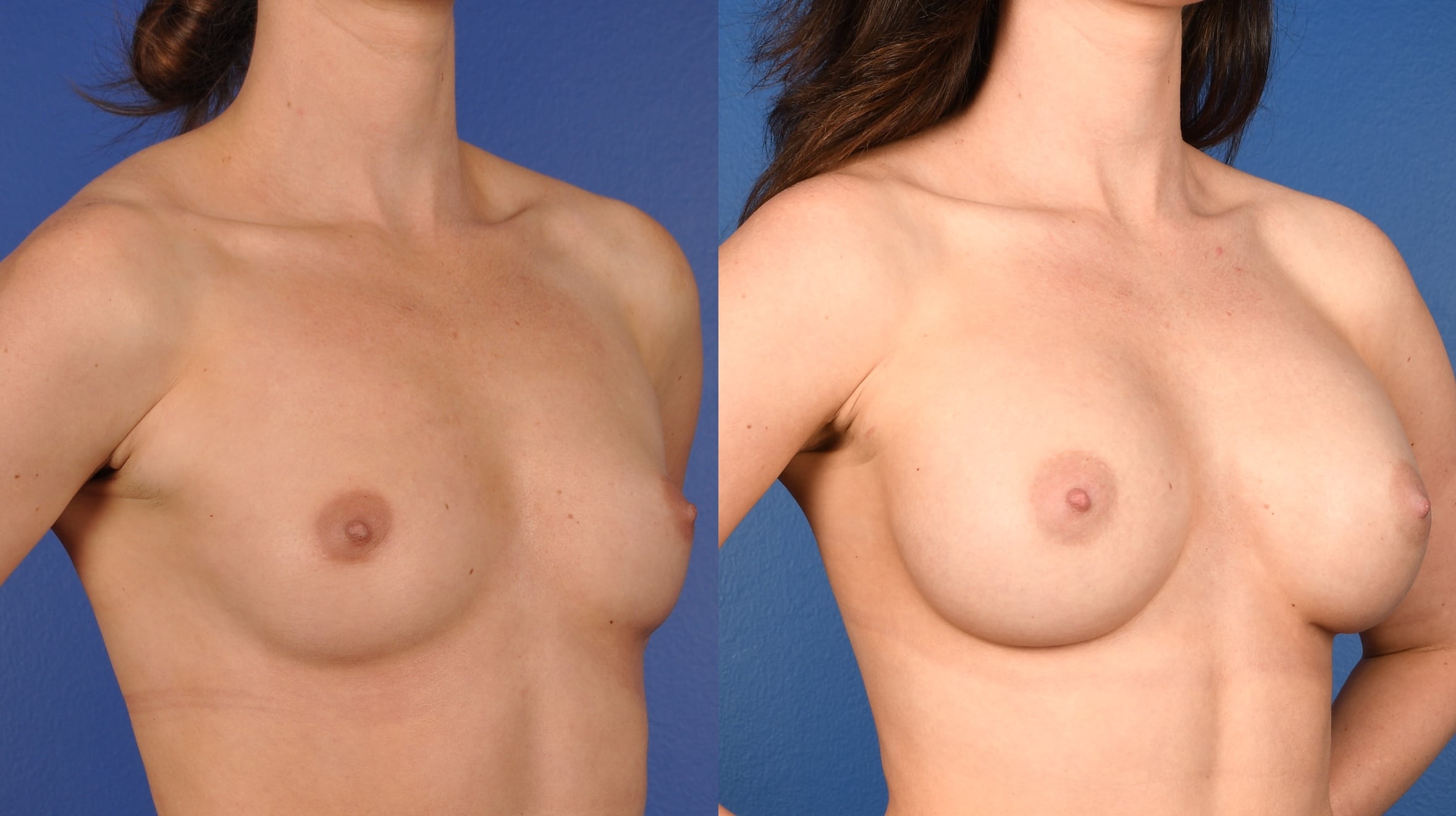 Before and After Image: Breast Augmentation – Silicone - right-front-oblique