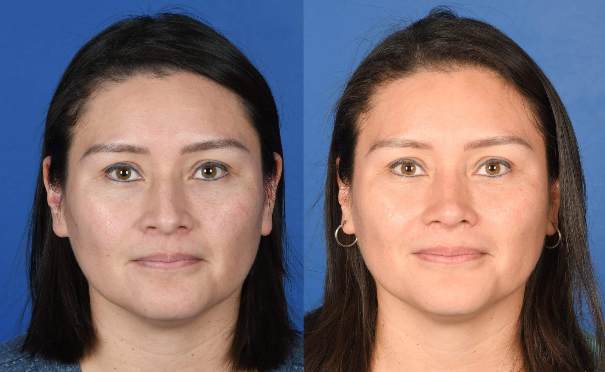Before and After Image: Primary Rhinoplasty - front