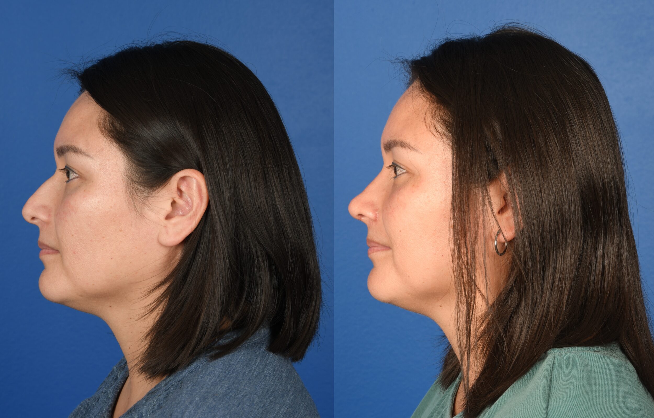 Before and After Image: Primary Rhinoplasty - left-side