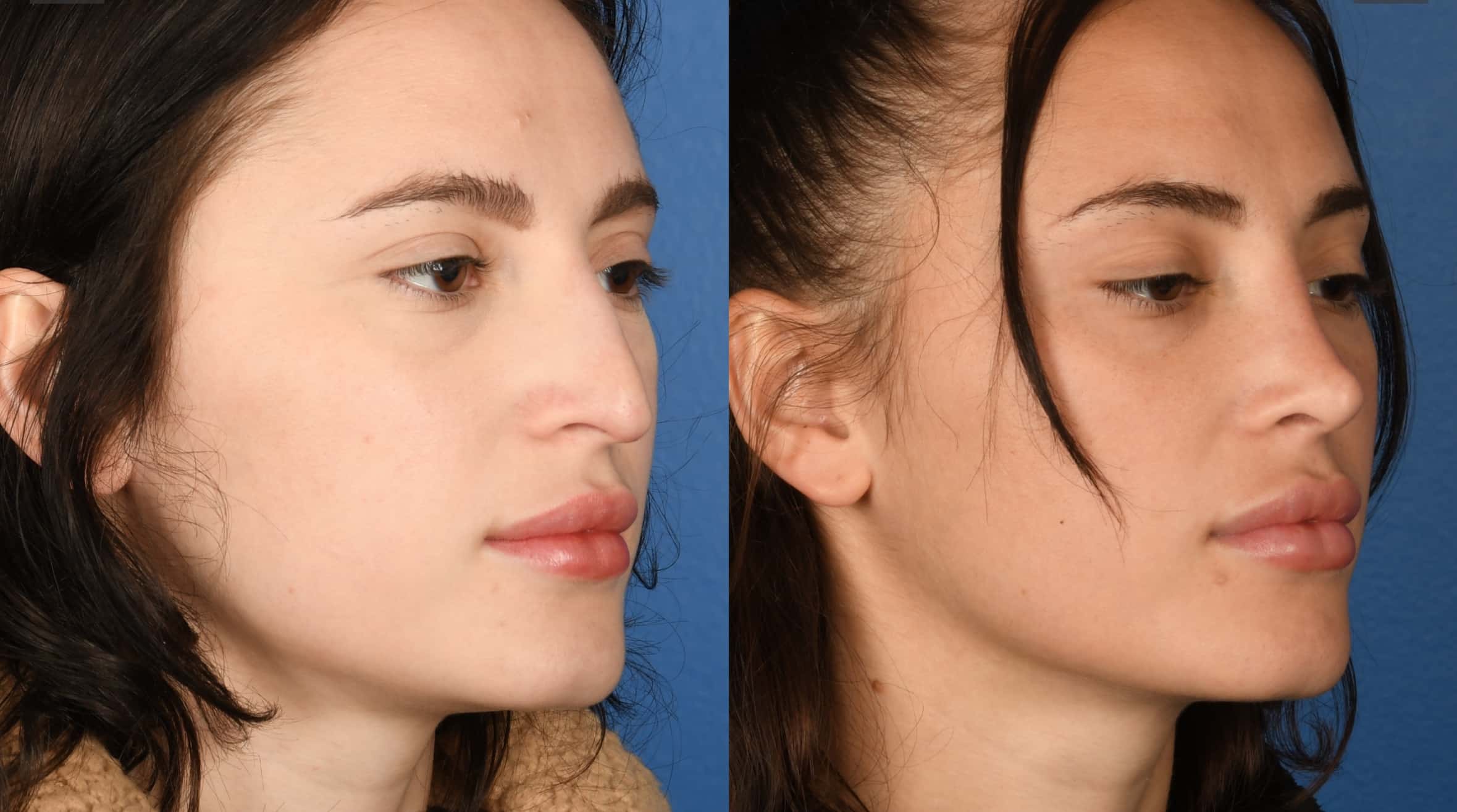 Before and After Image: Primary Rhinoplasty - right-front-oblique