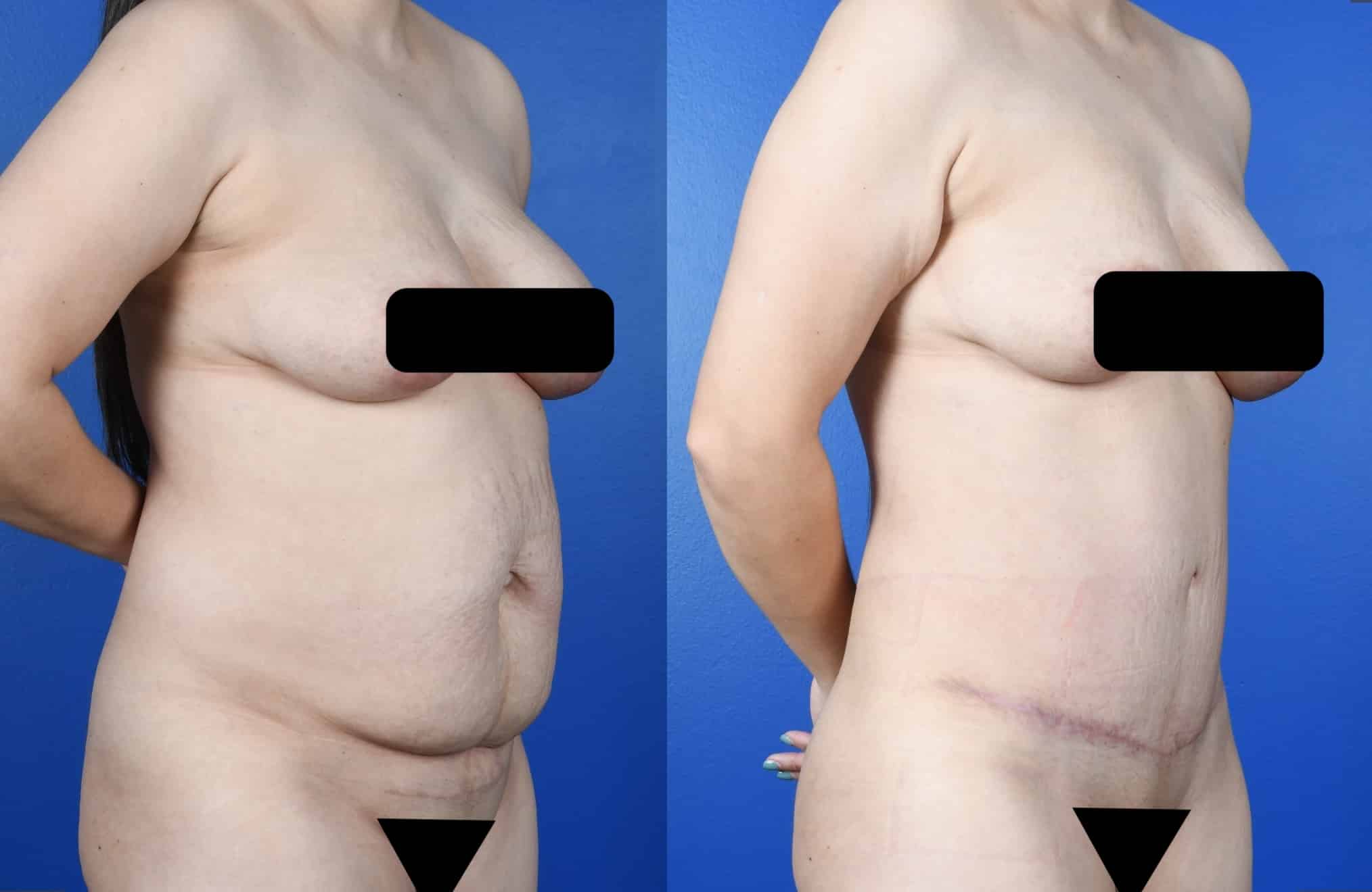 Before and After Image: Abdominoplasty, Fat Transfer to Buttocks - right-front-oblique