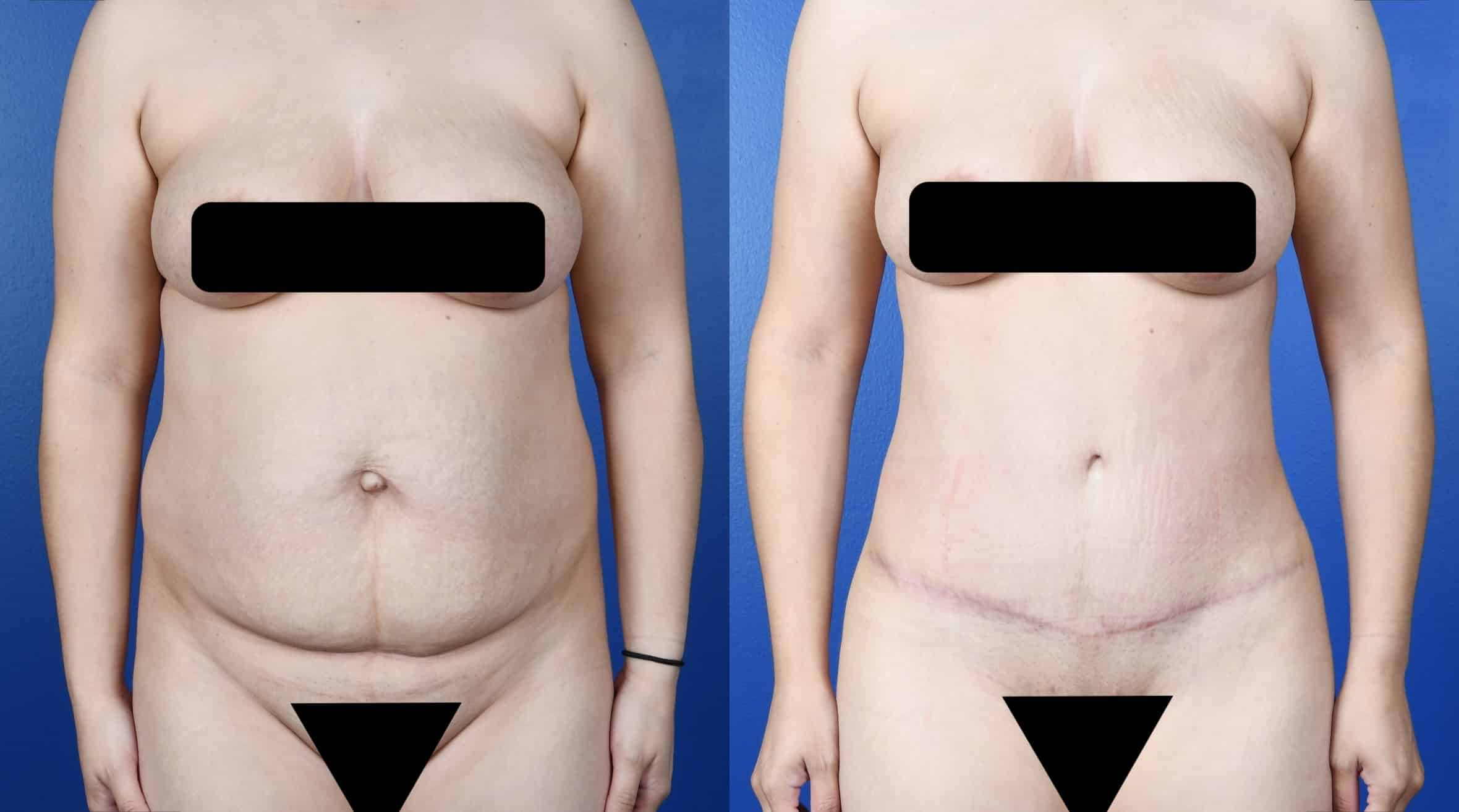 Before and After Image: Abdominoplasty, Fat Transfer to Buttocks - front