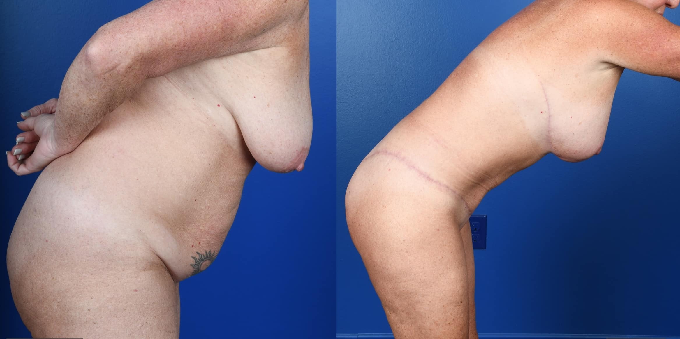 Before and After Image: Extended Abdominoplasty, Extended Mastopexy, Breast Augmentation –Silicone - other