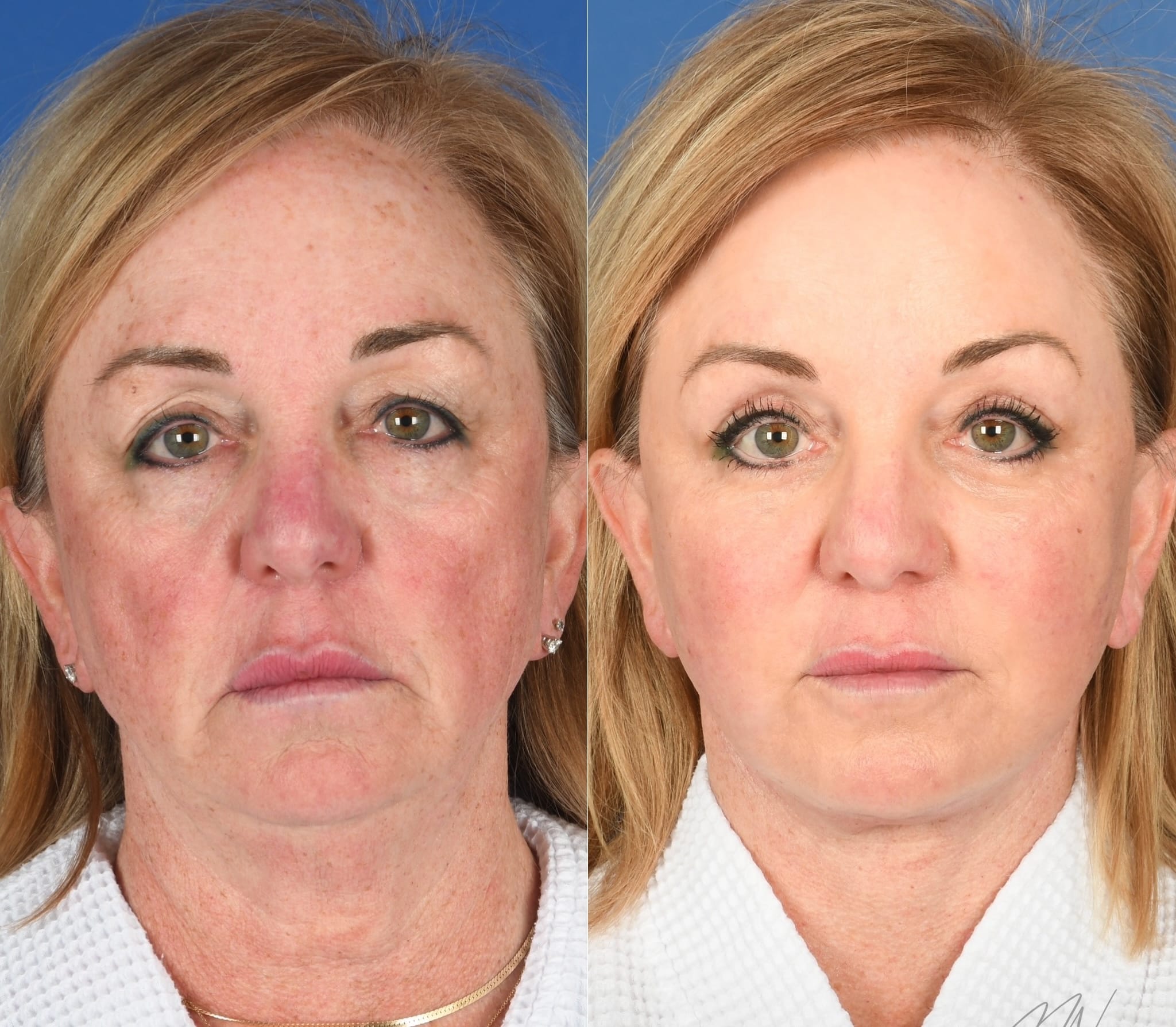 Before and After Image: Facelift, Facial Fat Grafting, Upper and Lower Blepharoplasty, Full Face Laser Resurfacing - front