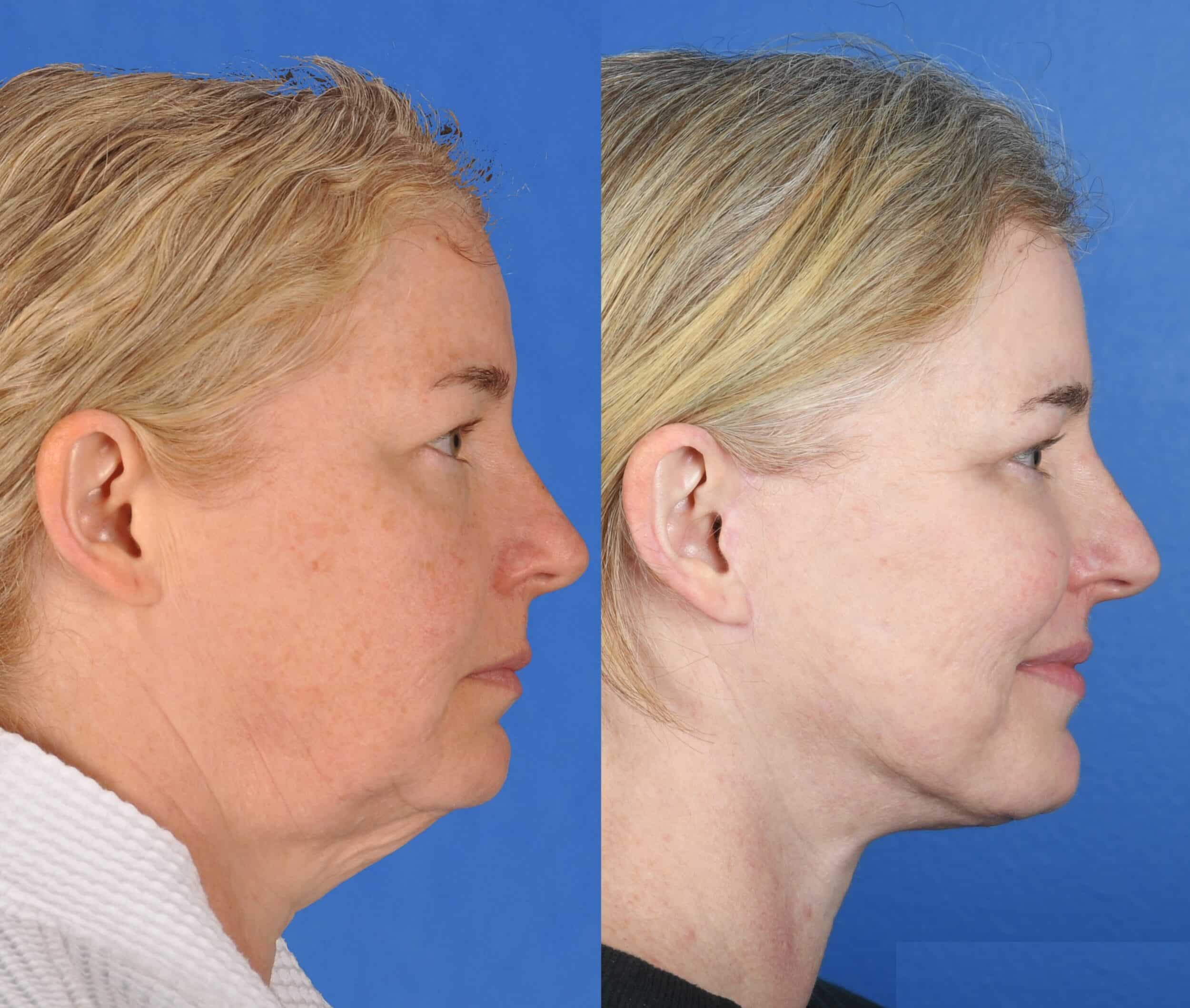 Before and After Image: Facelift, Upper and Lower Blepharoplasty, Full Face Laser - right-side
