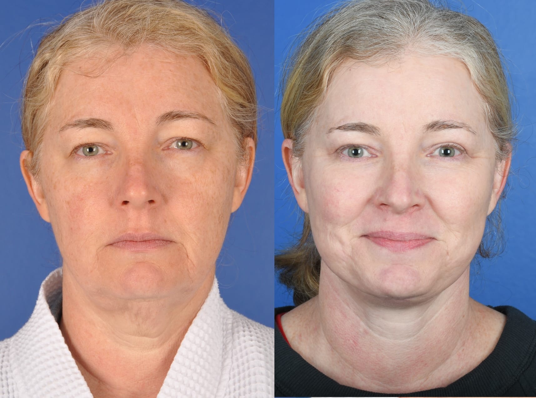 Before and After Image: Facelift, Upper and Lower Blepharoplasty, Full Face Laser - front