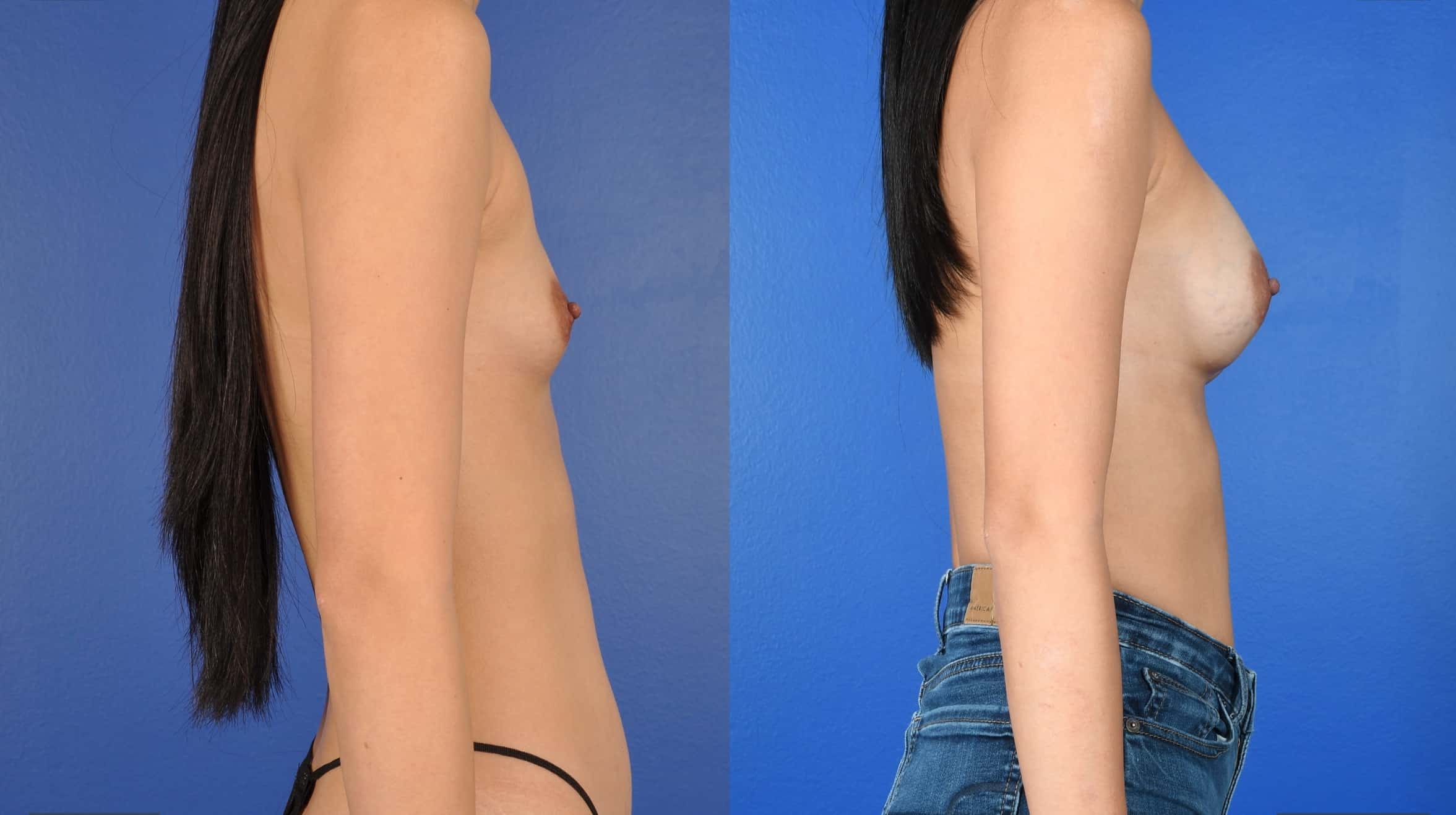 Before and After Image: Breast Augmentation-Silicone - right-side