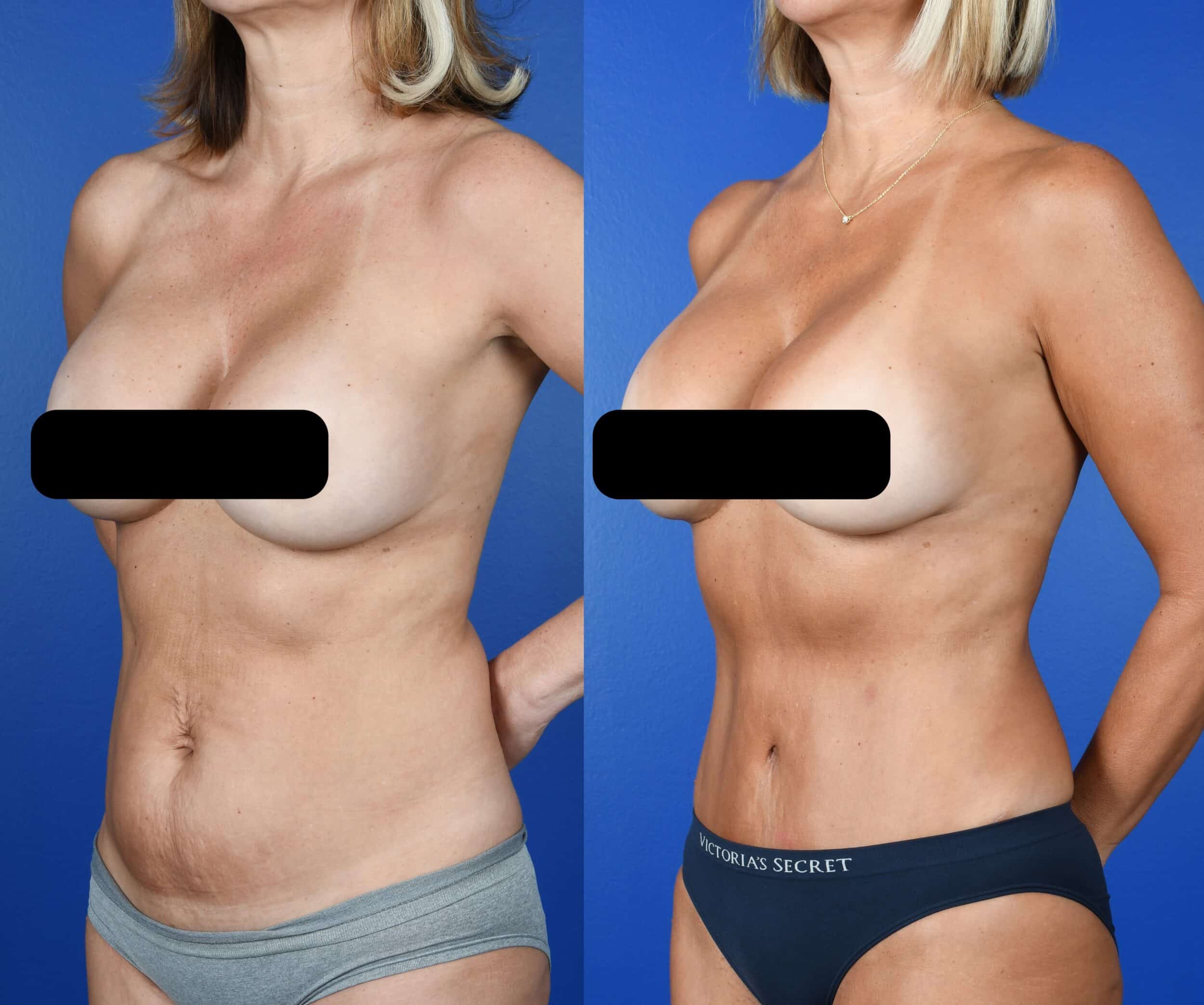 Before and After Image: Abdominoplasty, Flank Liposuction - left-front-oblique