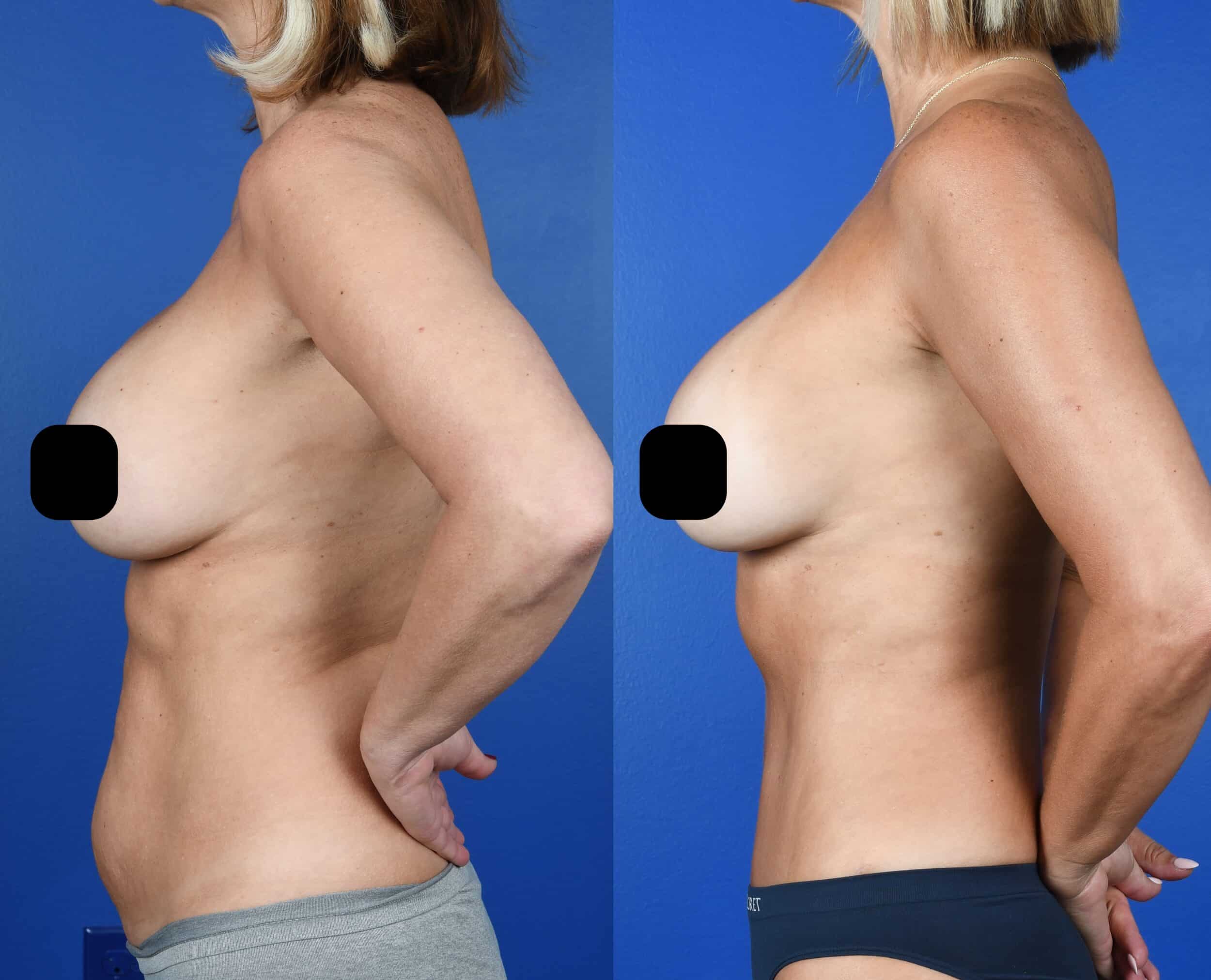 Before and After Image: Abdominoplasty, Flank Liposuction - left-side