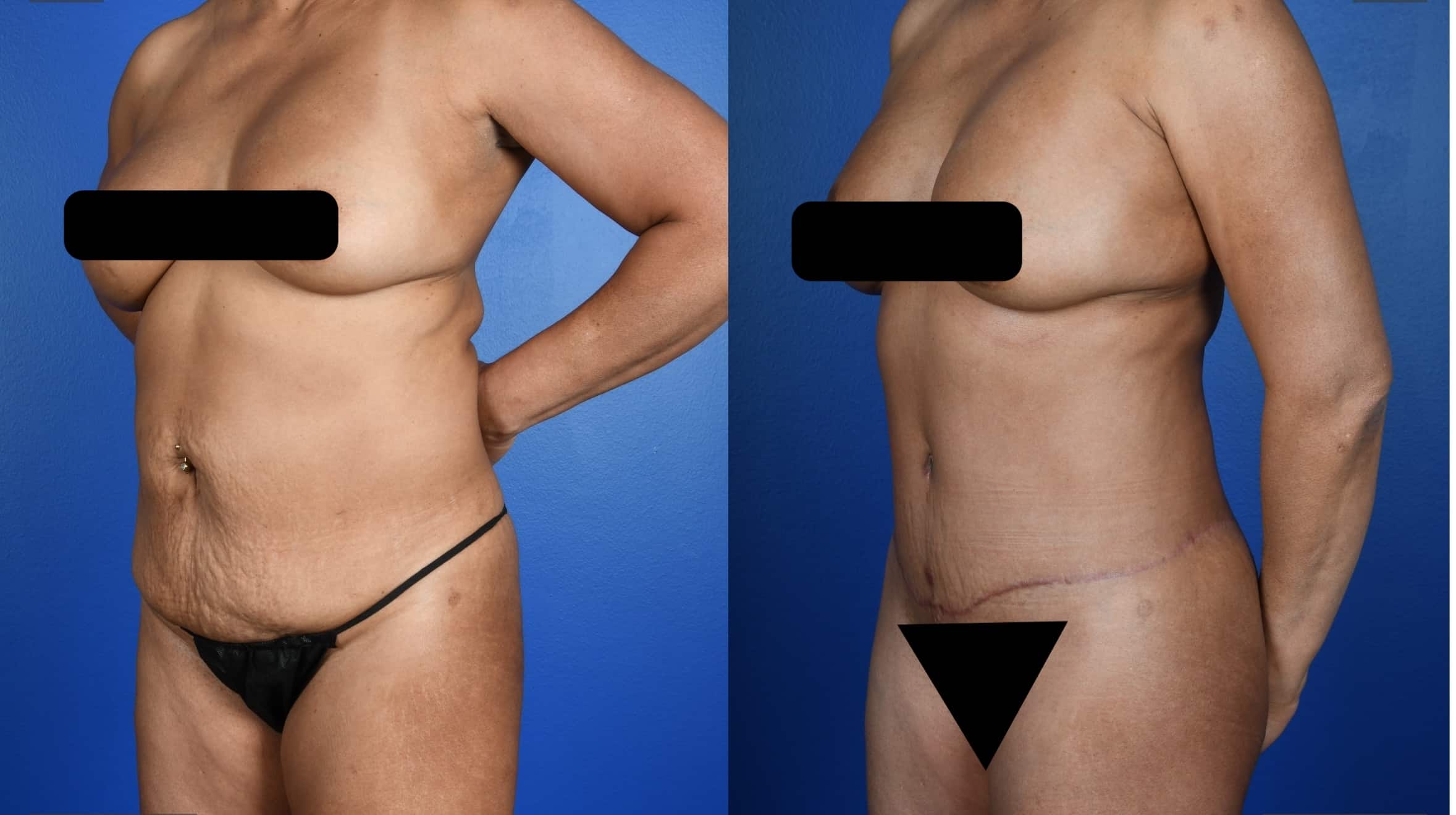 Before and After Image: Standard Abdominoplasty, 360 Liposuction, Liposuction-Upper Back - left-front-oblique