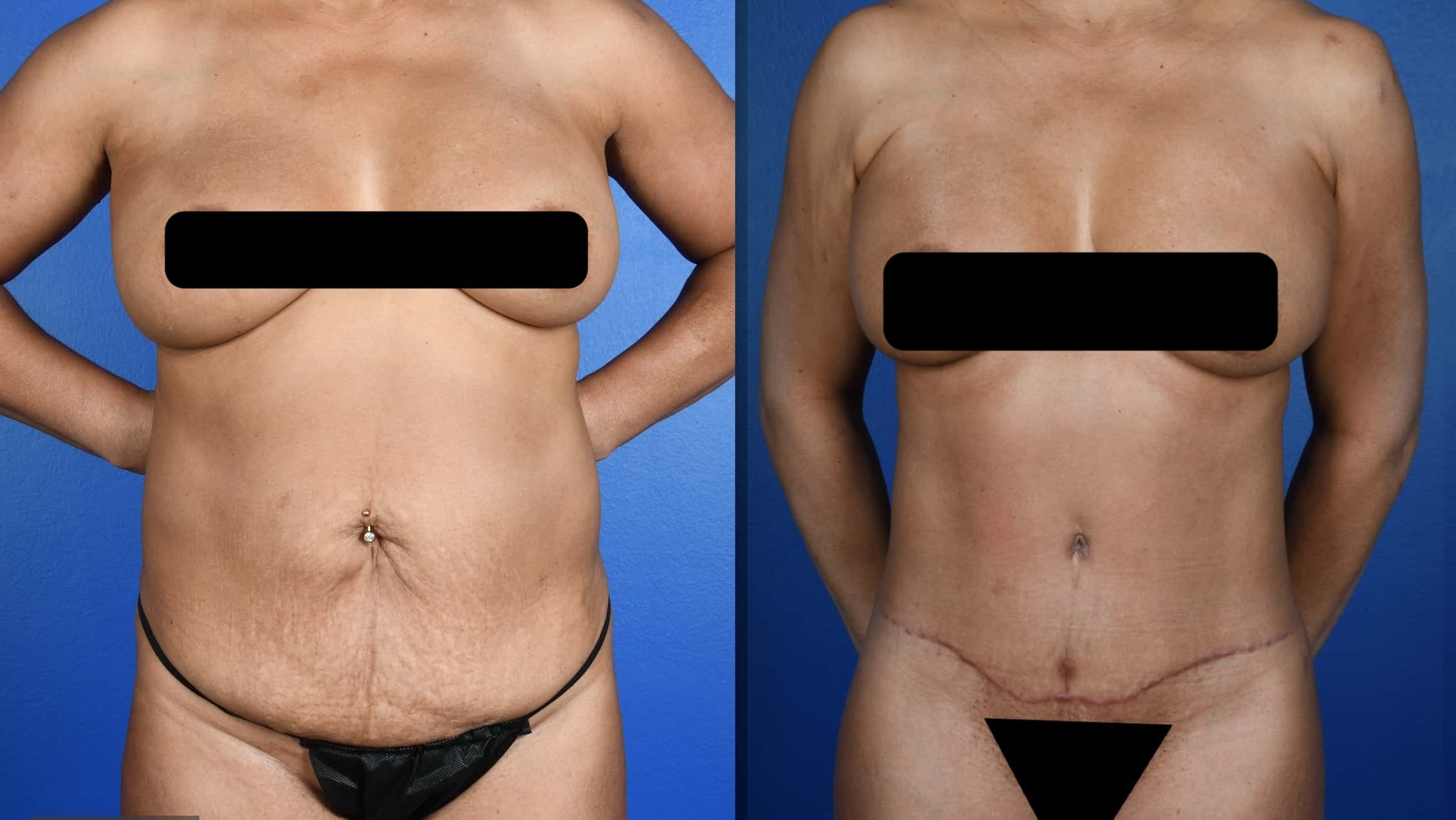 Before and After Image: Standard Abdominoplasty, 360 Liposuction, Liposuction-Upper Back - front