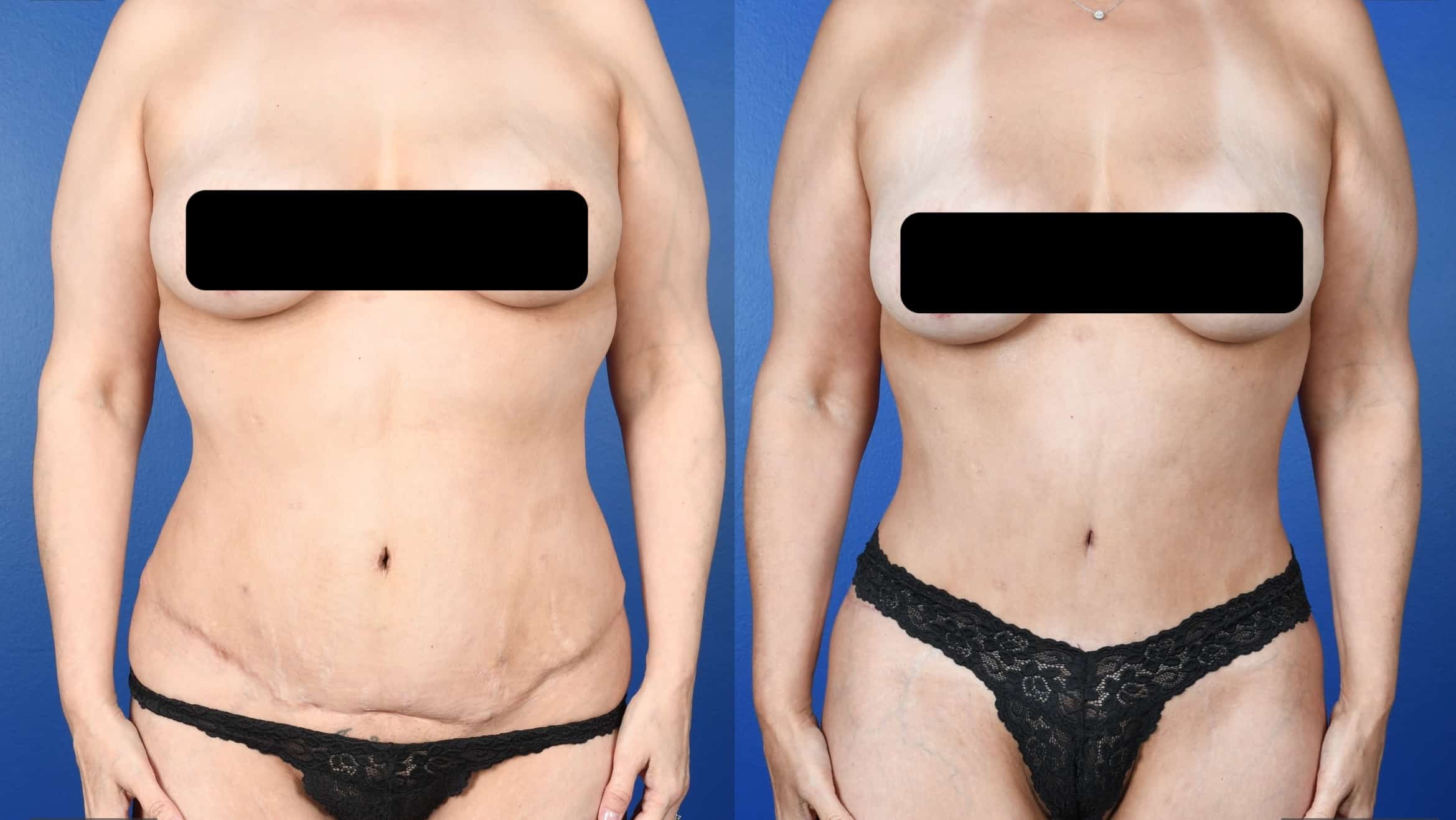 Before and After Image: Lower Bodylift with Gluteal Autoaugmentation, 360 Liposuction, Abdominoplasty Revision - back