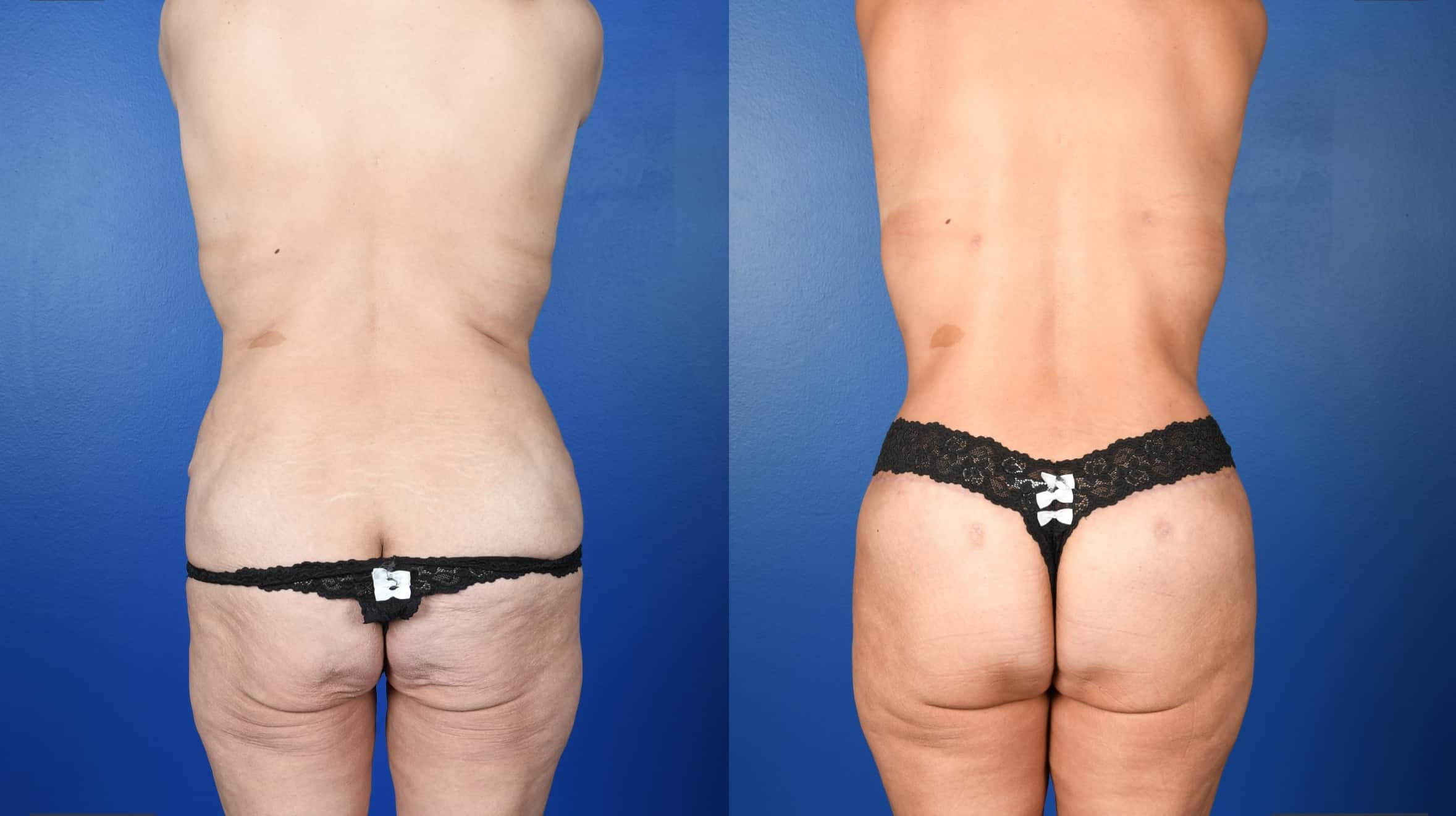 Before and After Image: Lower Bodylift with Gluteal Autoaugmentation, 360 Liposuction, Abdominoplasty Revision - back