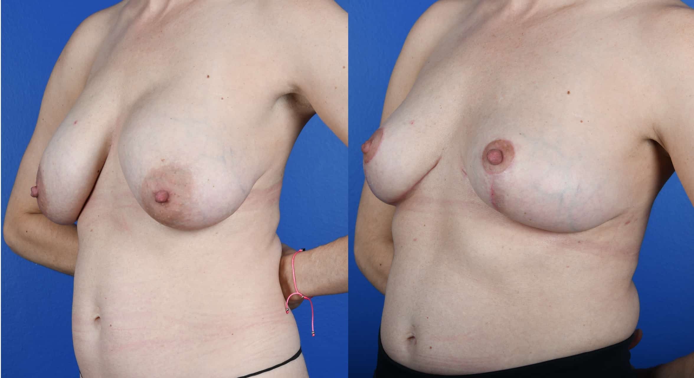 Before and After Image: Breast Implant Removal, Mastopexy, Fat Grafting to Breasts, Galaflex Mesh - left-front-oblique