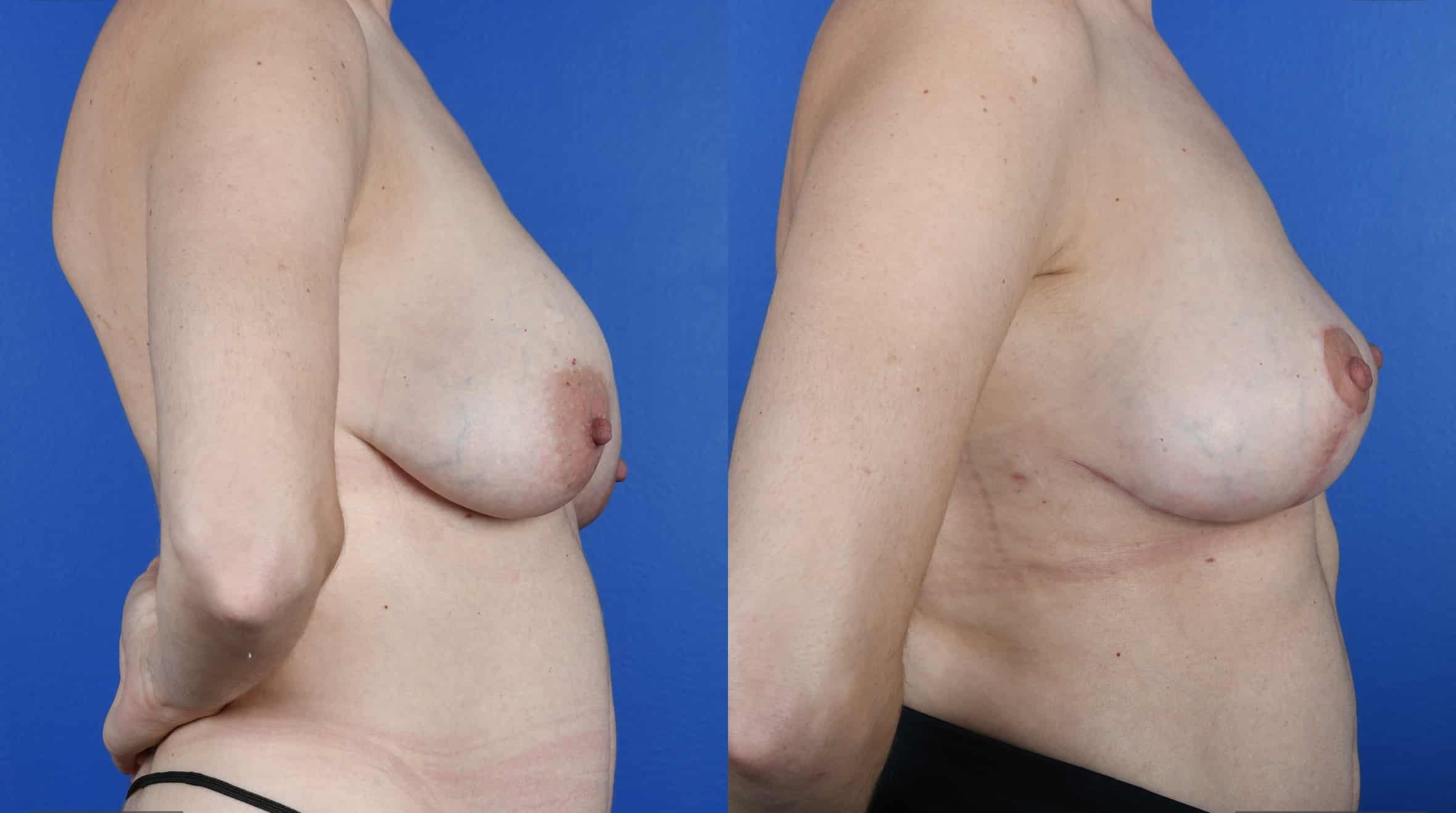 Before and After Image: Breast Implant Removal, Mastopexy, Fat Grafting to Breasts, Galaflex Mesh - right-side