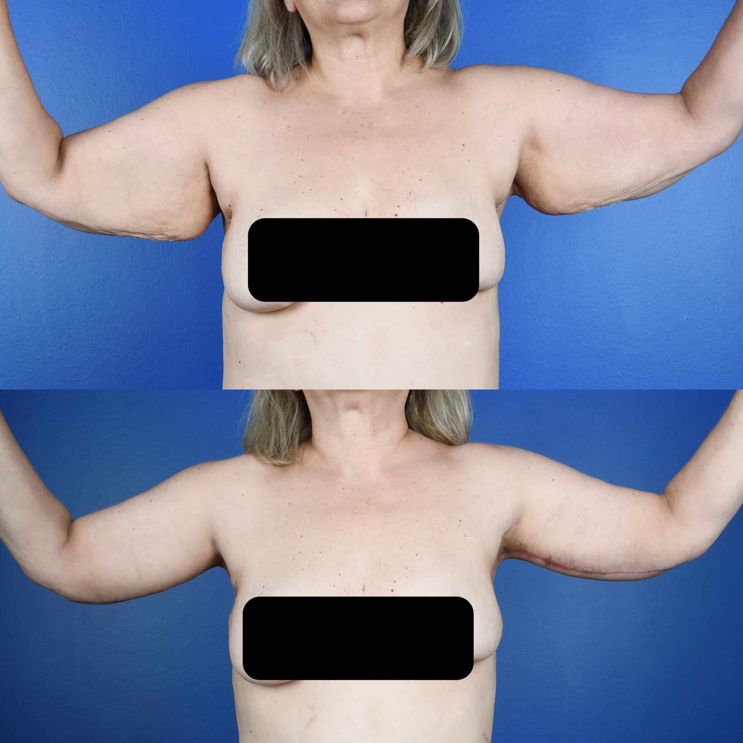Before and After Image: Brachioplasty - front