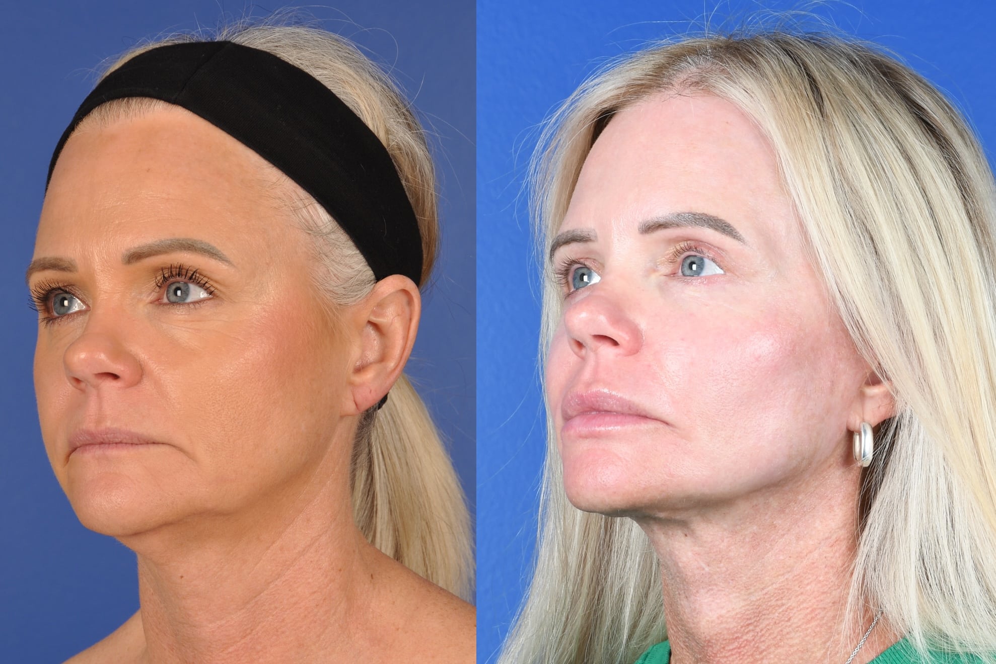 Before and After Image: Facelift, Facial Fat Grafting, Upper and Lower Blepharoplasty, Full Face Laser Resurfacing - left-front-oblique