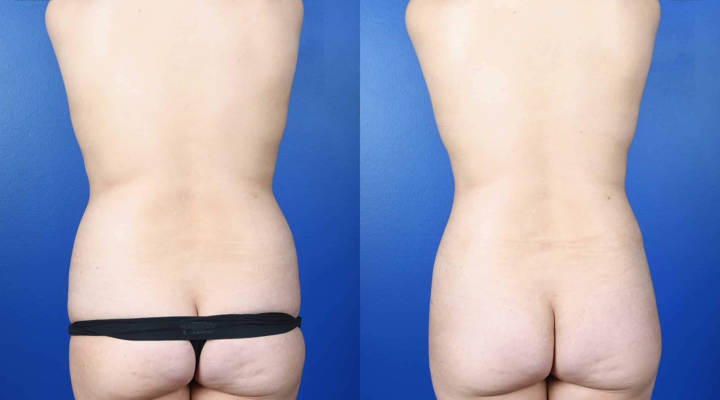Before and After Image: Extended Abdominoplasty, Flank Liposuction, Breast Augmentation-Silicone - back
