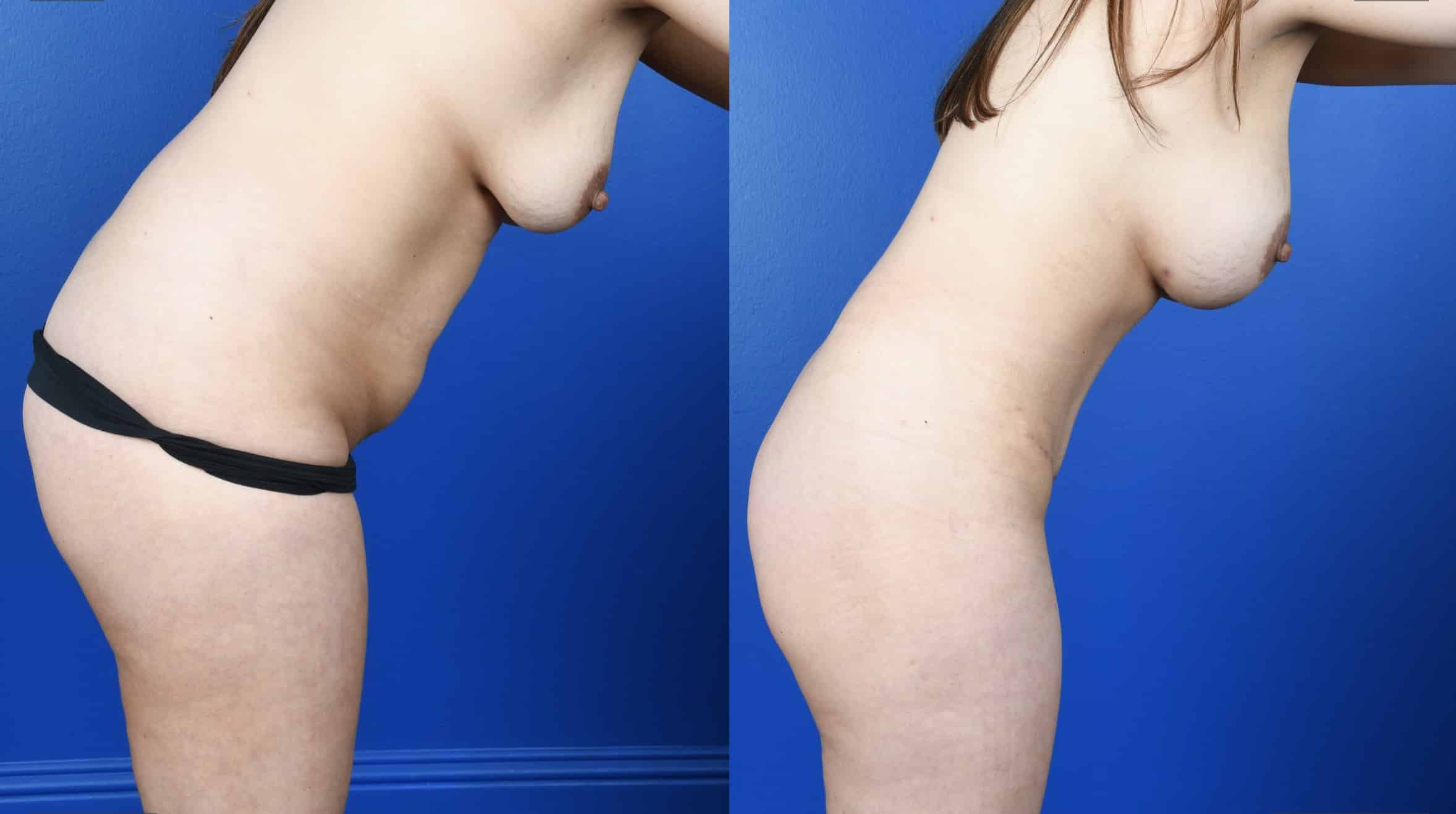 Before and After Image: Extended Abdominoplasty, Flank Liposuction, Breast Augmentation-Silicone - other