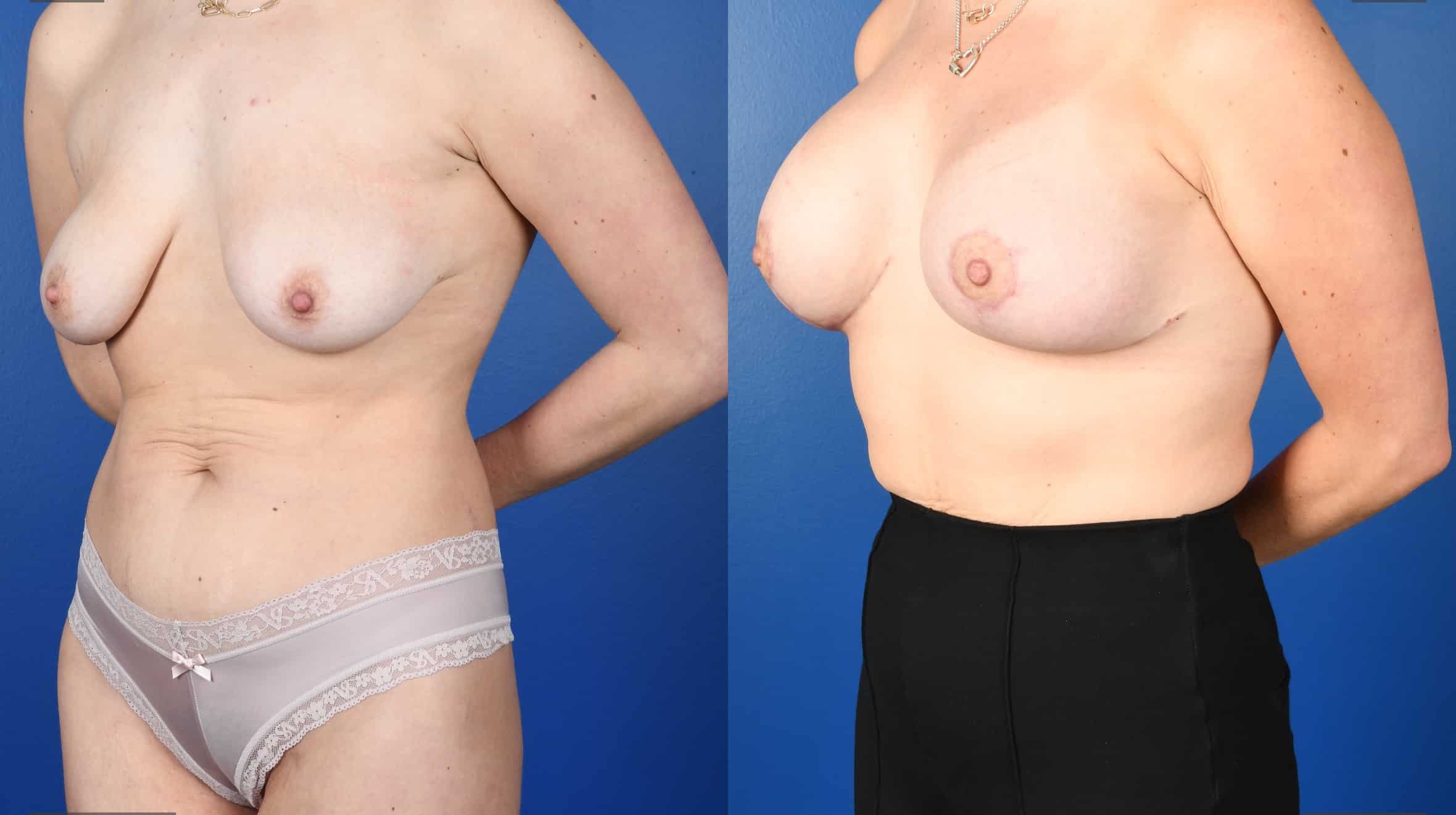 Before and After Image: Mastopexy, Breast Augmentation-Silicone - left-front-oblique