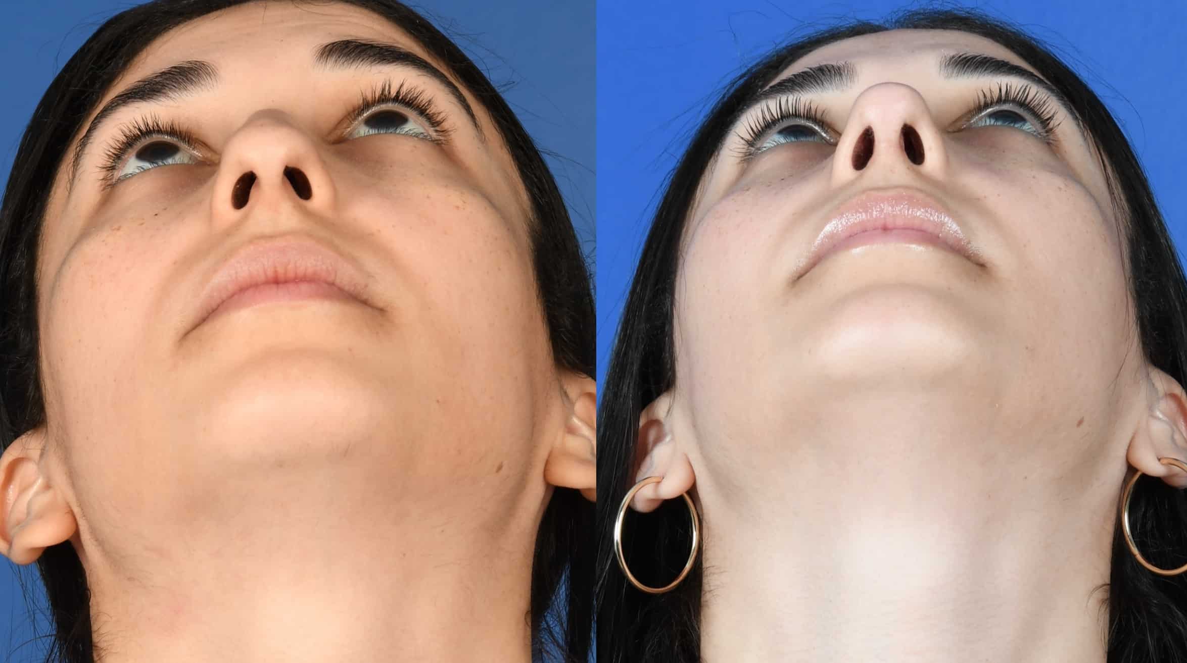 Before and After Image: Primary Rhinoplasty - other