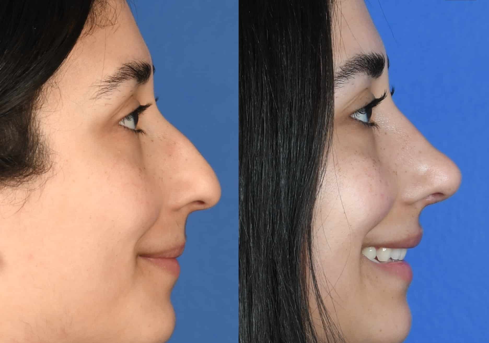 Before and After Image: Primary Rhinoplasty - right-side