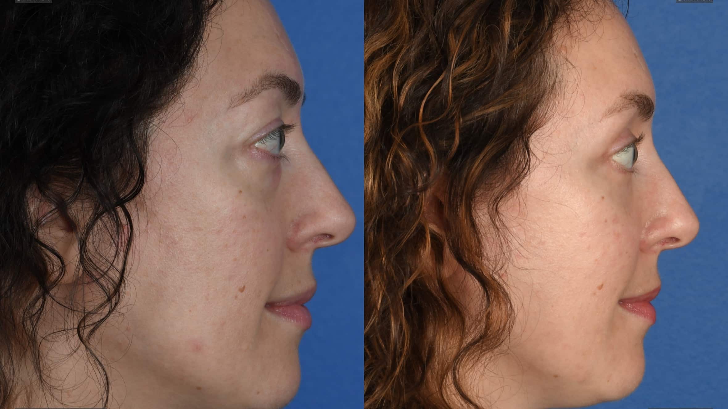 Before and After Image: Upper and Lower Blepharoplasty - right-side