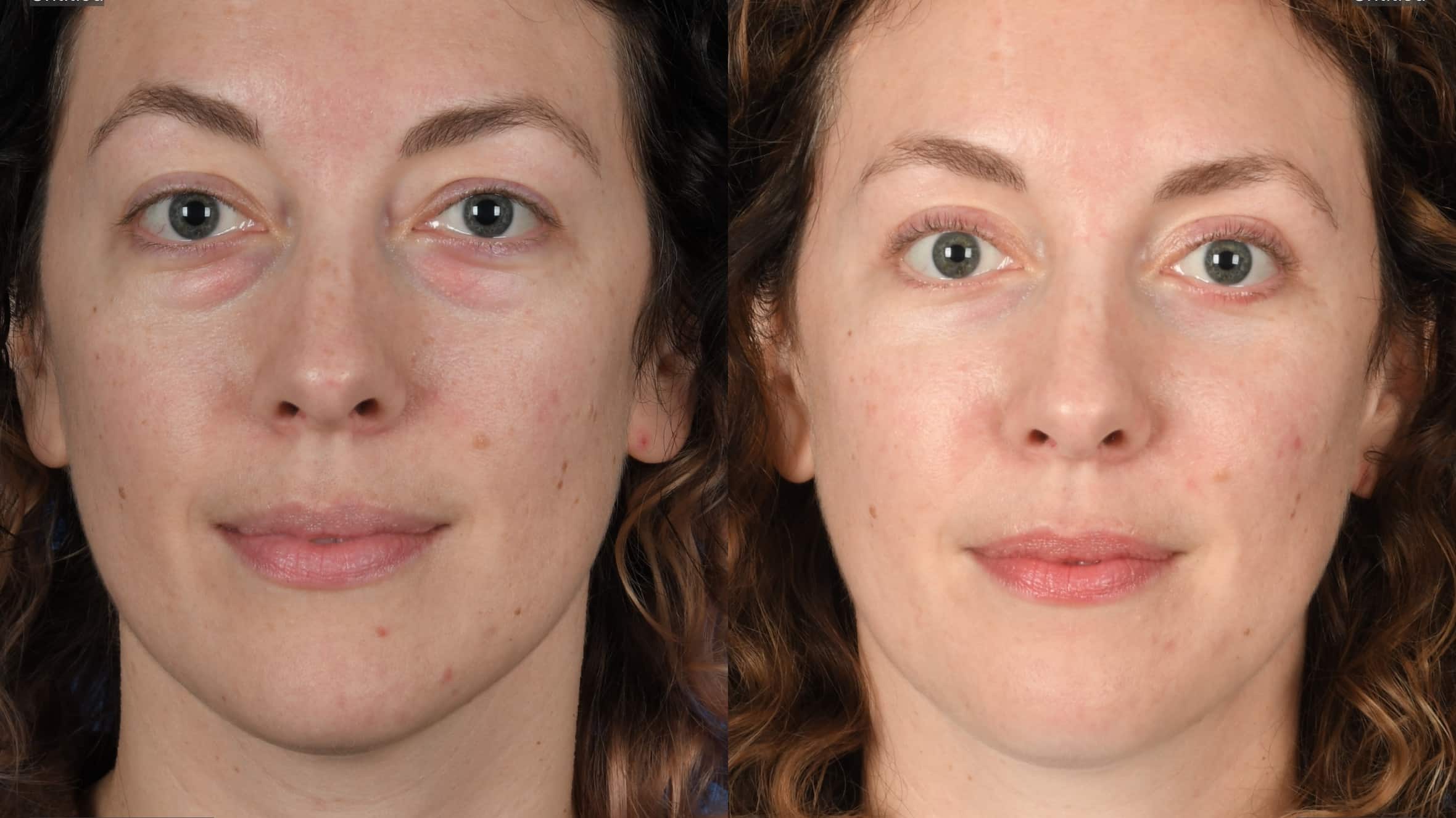 Before and After Image: Upper and Lower Blepharoplasty - front