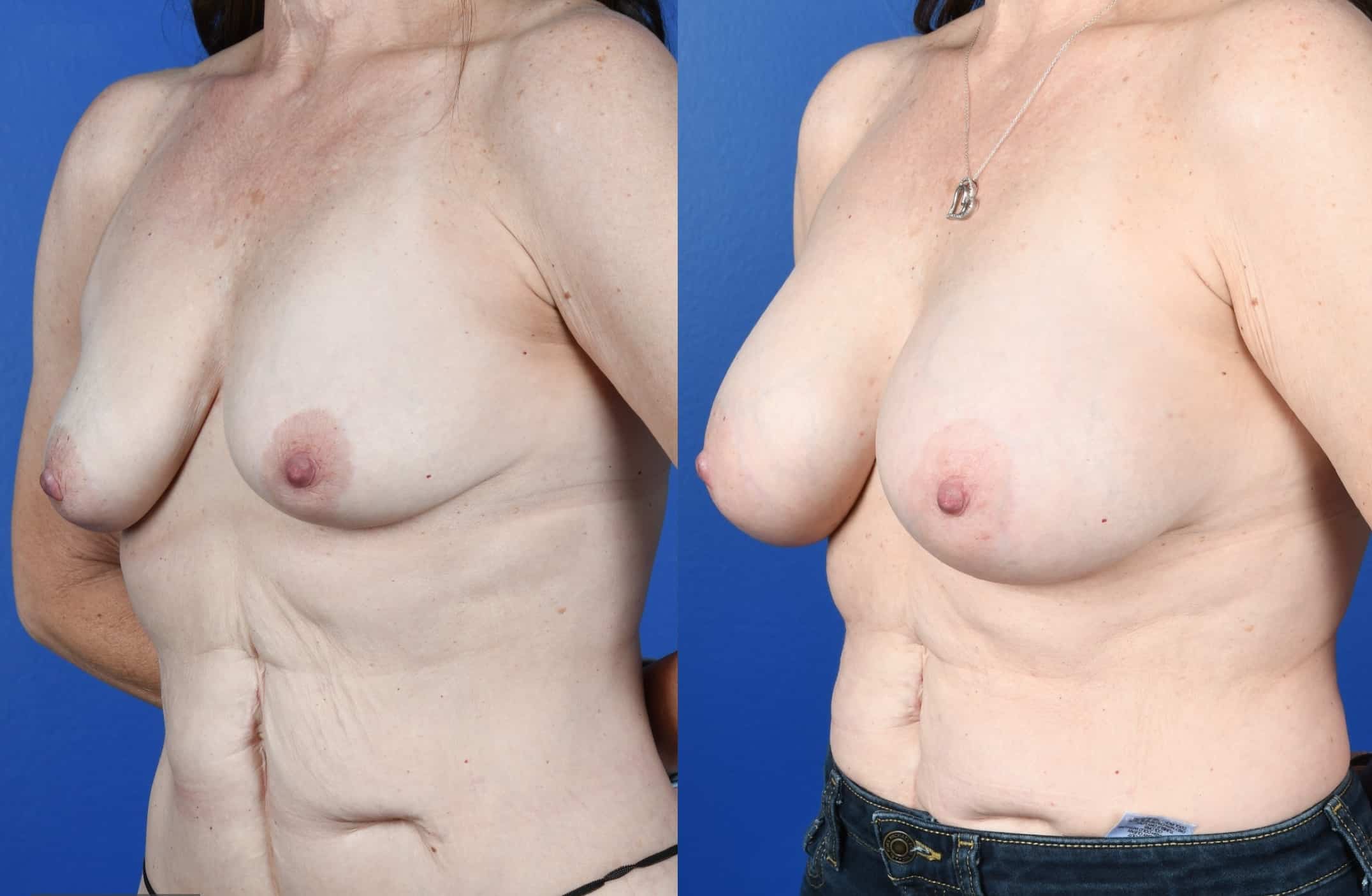 Before and After Image: Breast Augmentation – Silicone - left-front-oblique