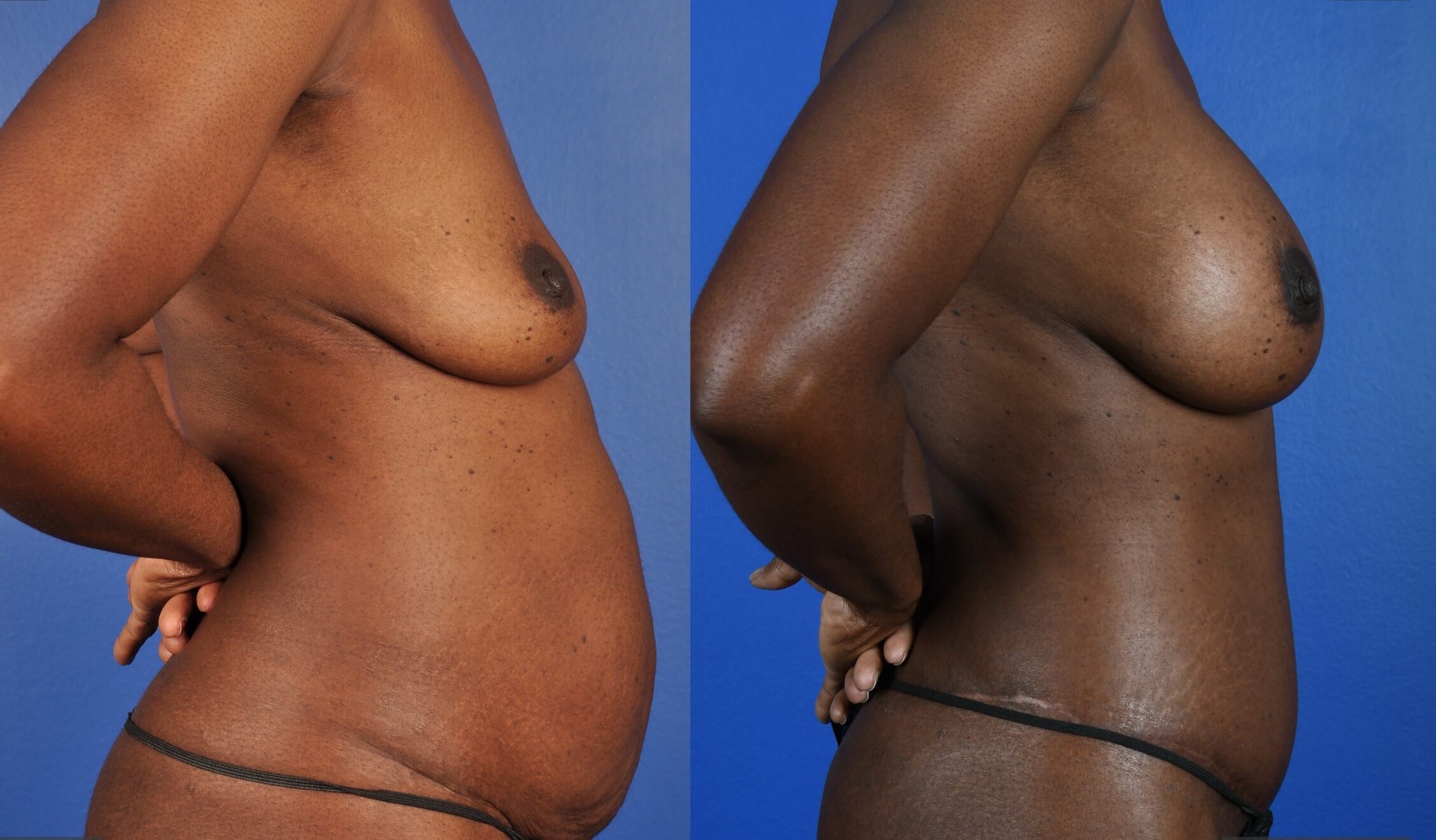 Before and After Image: Abdominoplasty – Extended, Breast Augmentation – Silicone - right-side