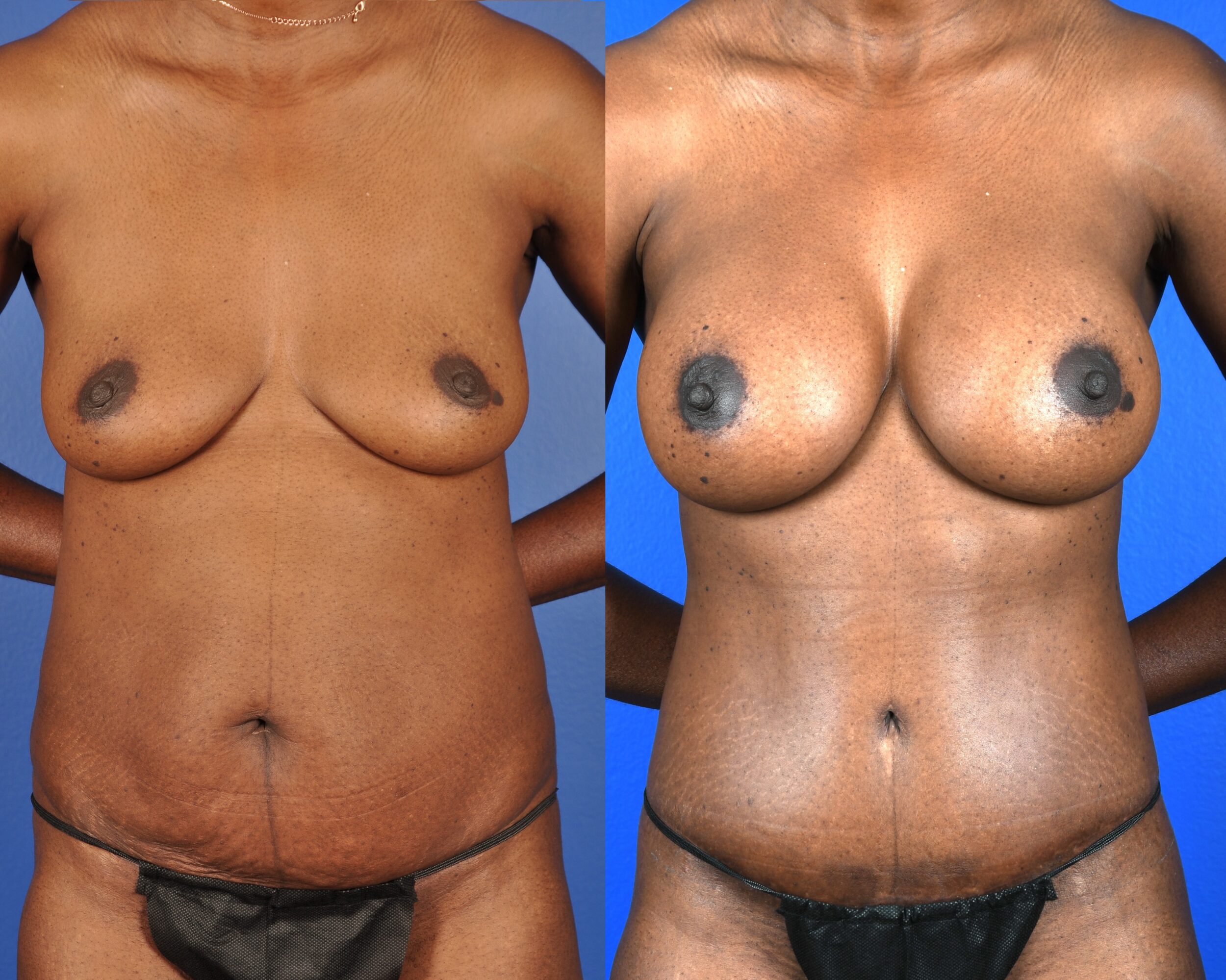 Before and After Image: Abdominoplasty – Extended, Breast Augmentation – Silicone - front