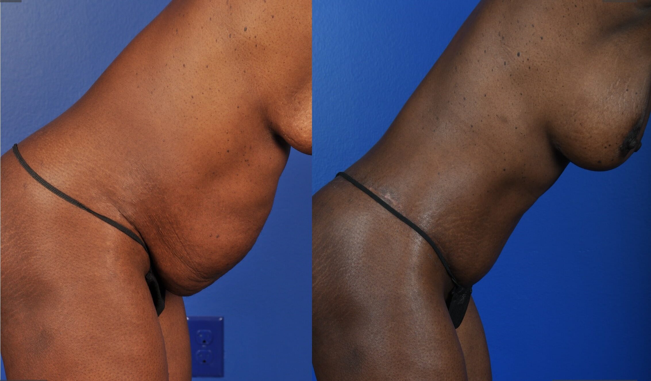 Before and After Image: Abdominoplasty – Extended, Breast Augmentation – Silicone - other