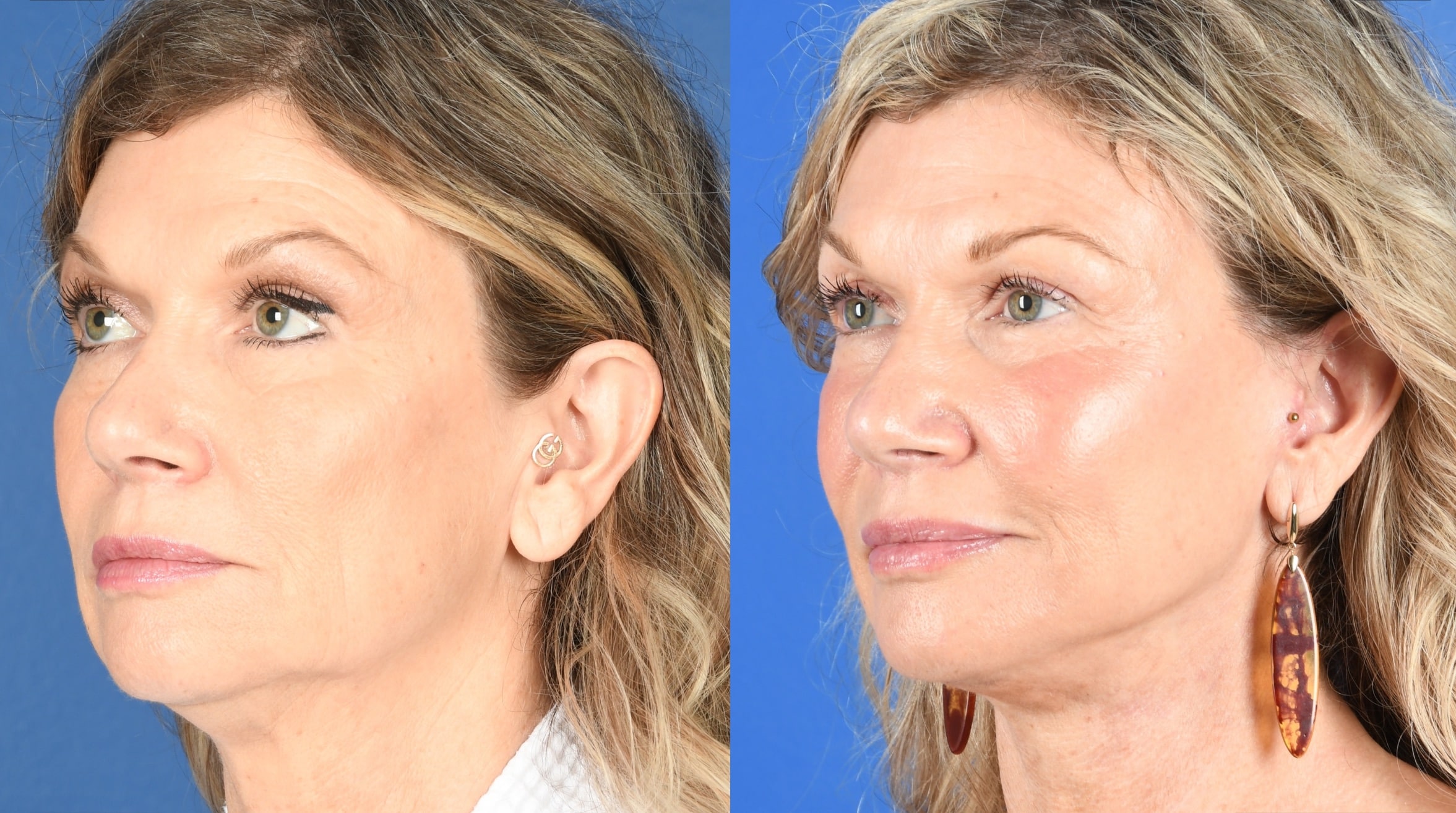 Before and After Image: Facelift, Full Face Laser - left-front-oblique