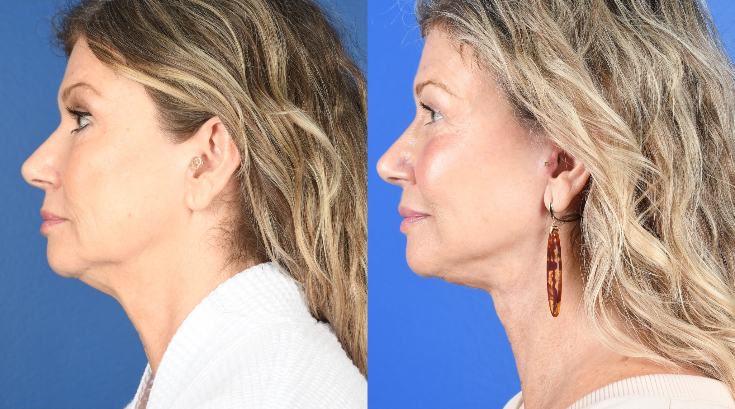 Before and After Image: Facelift, Full Face Laser - left-side