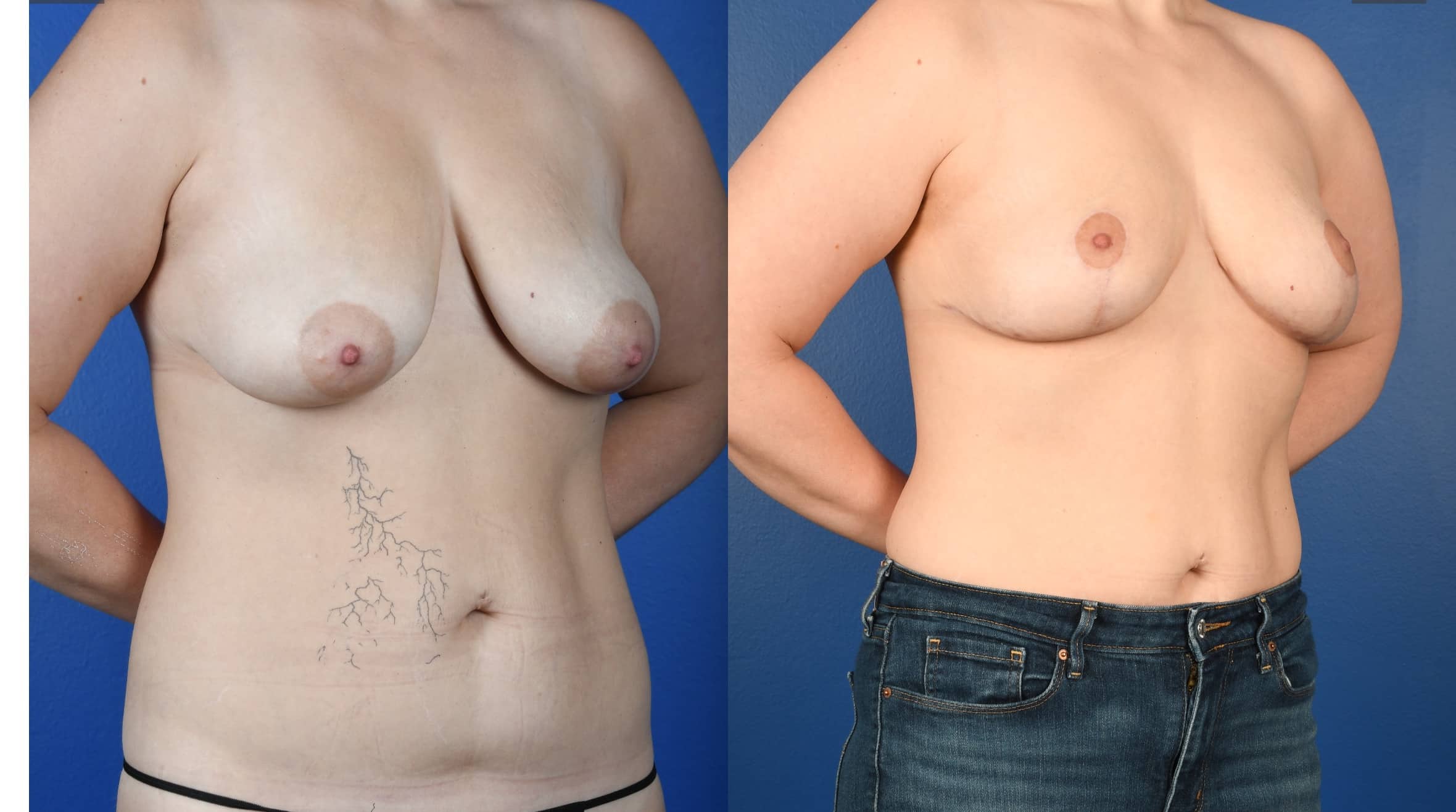 Before and After Image: Mastopexy - right-front-oblique