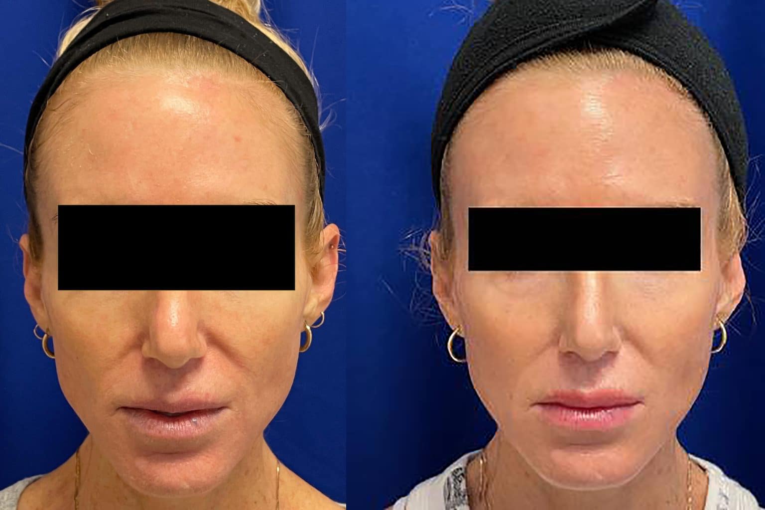 Before and After Image: Sculptra - front