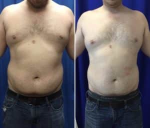 Before and After Image: CoolSculpting - front
