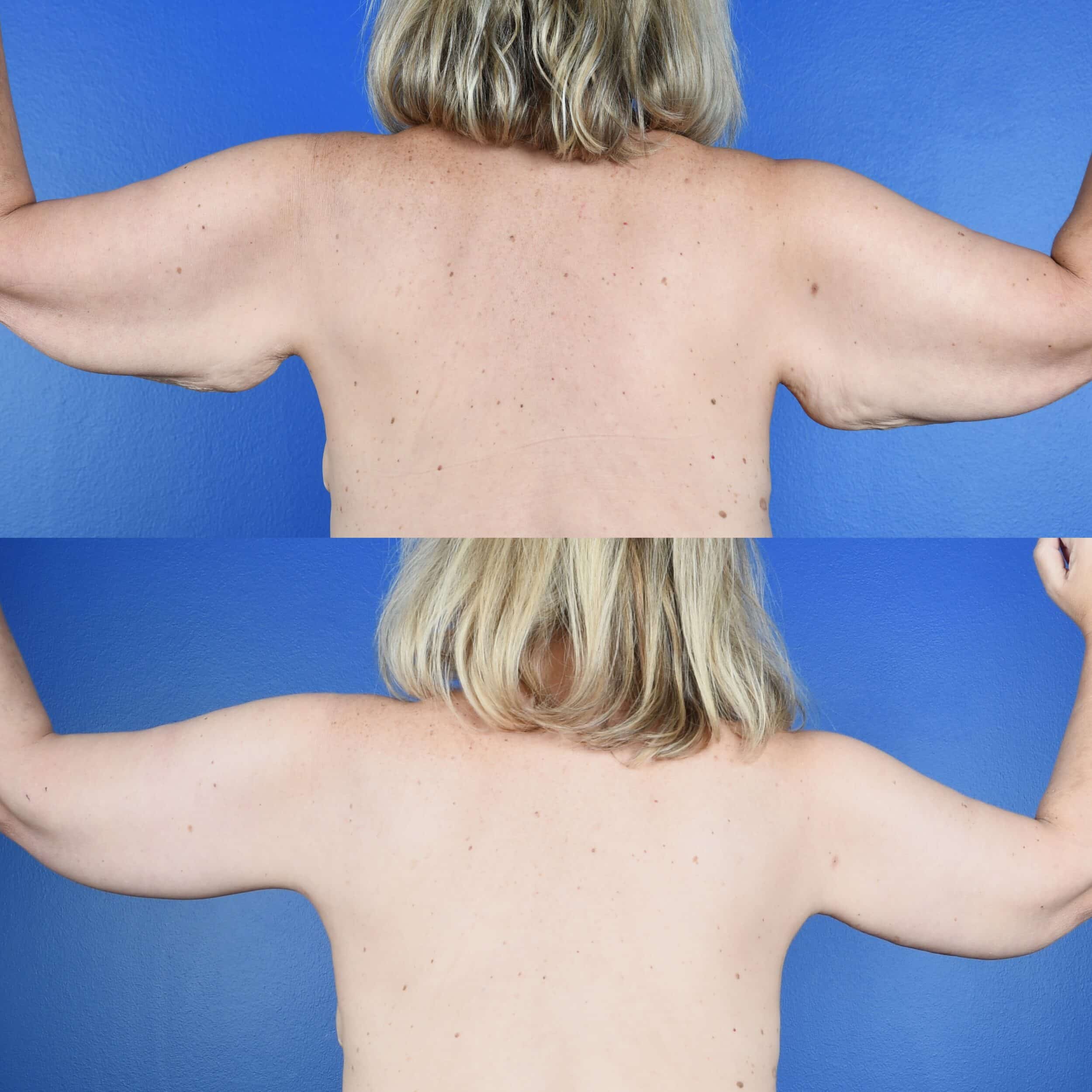 Before and After Image: Brachioplasty - back