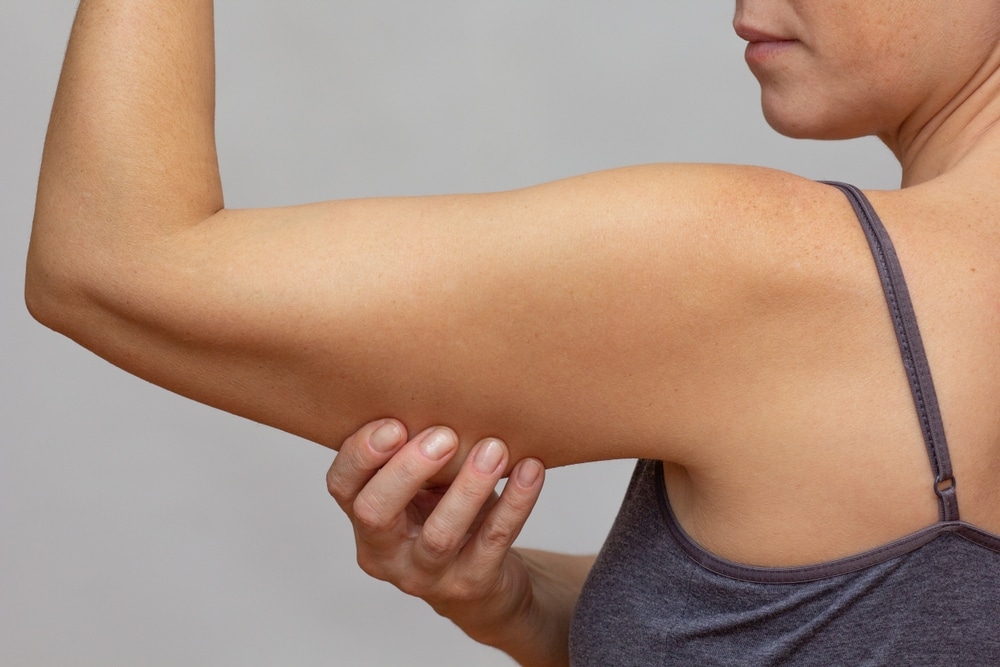 A close-up shot of a woman's upper arm before an arm lift in Southlake