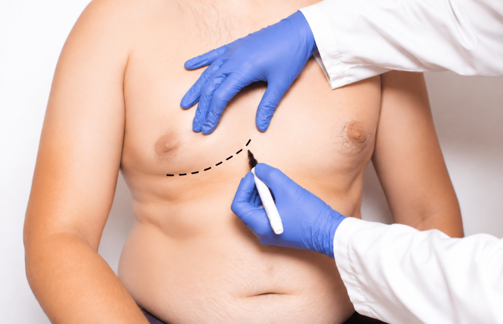 A doctor marking a man's chest for gynecomastia surgery in Southlake